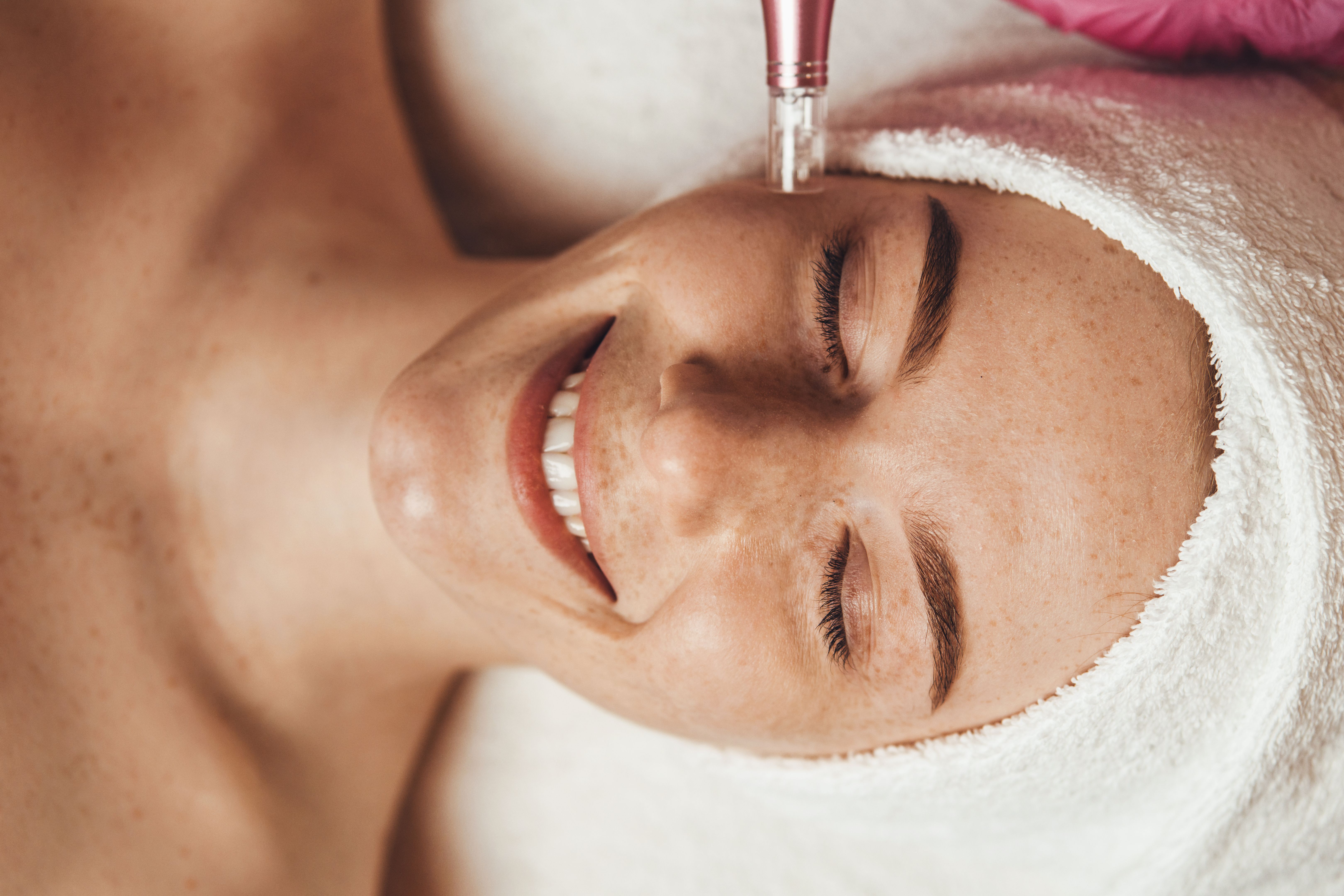 microneedling treatment