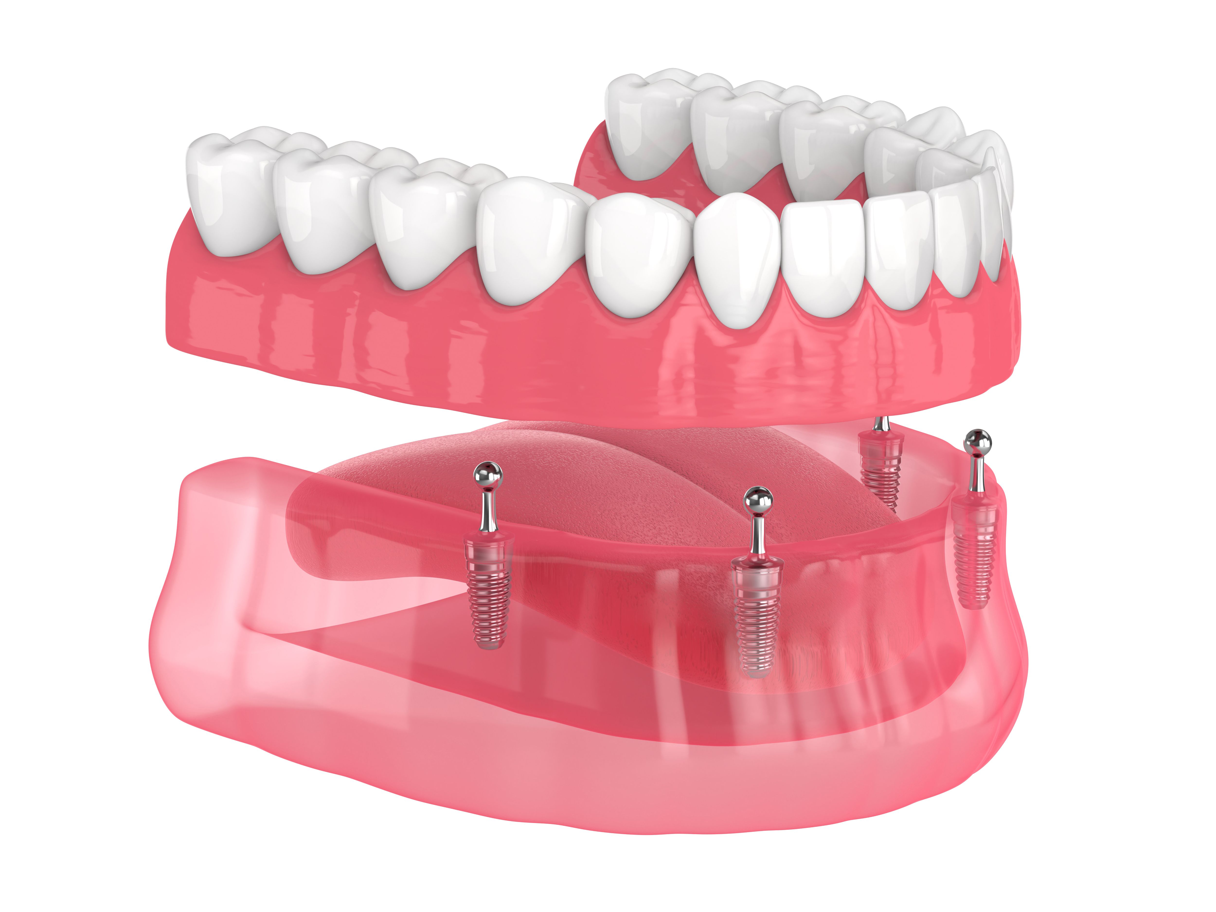 comparing dentures implants