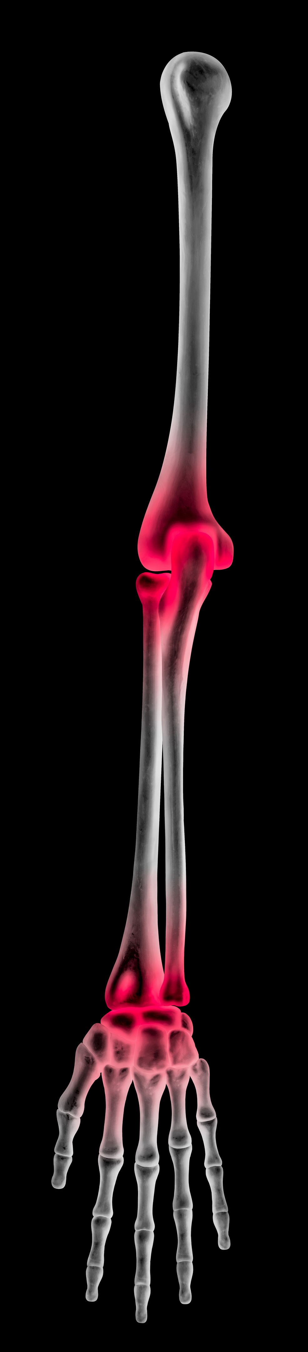 inflamação articulações