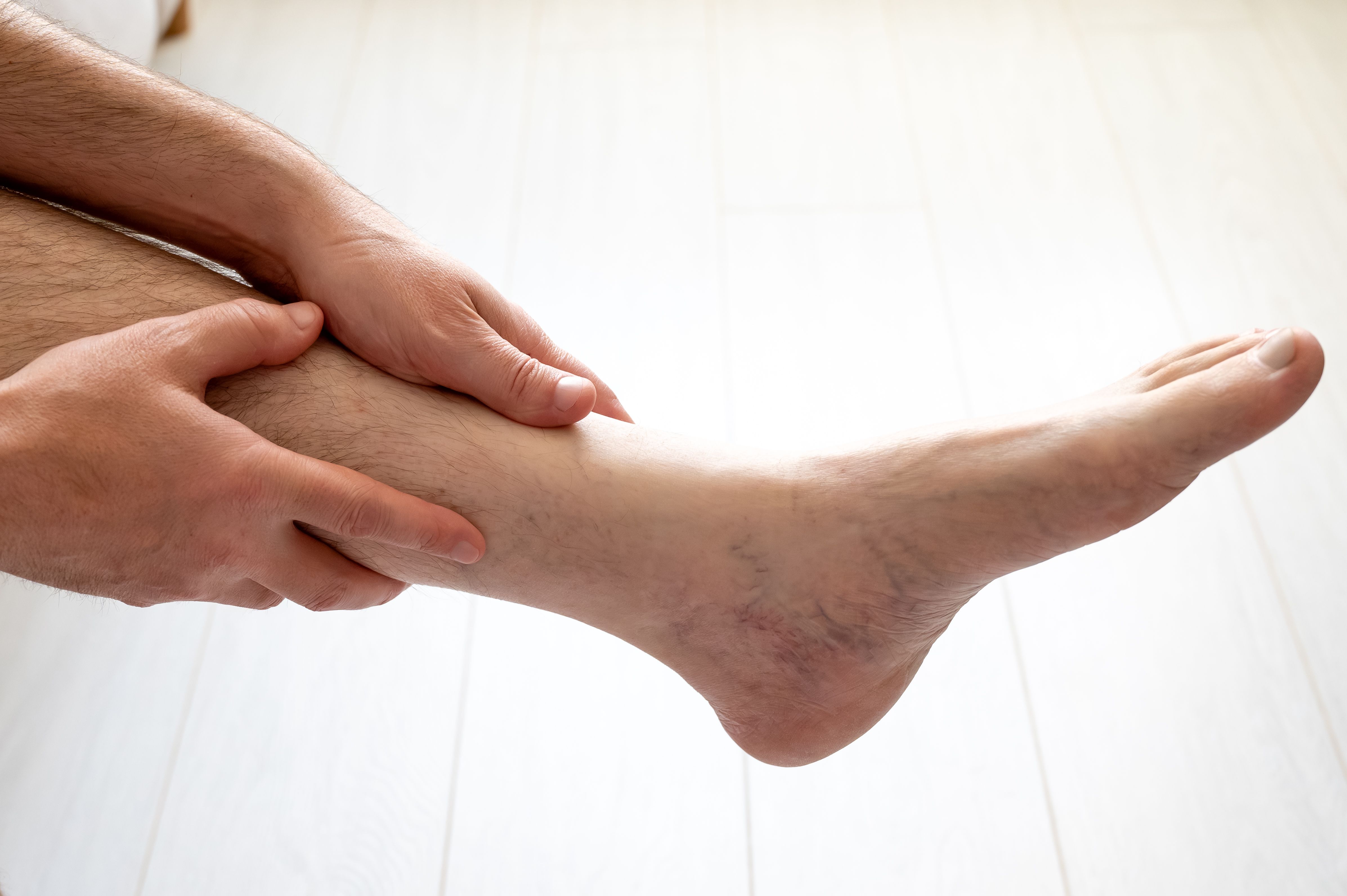 consultation varicose veins