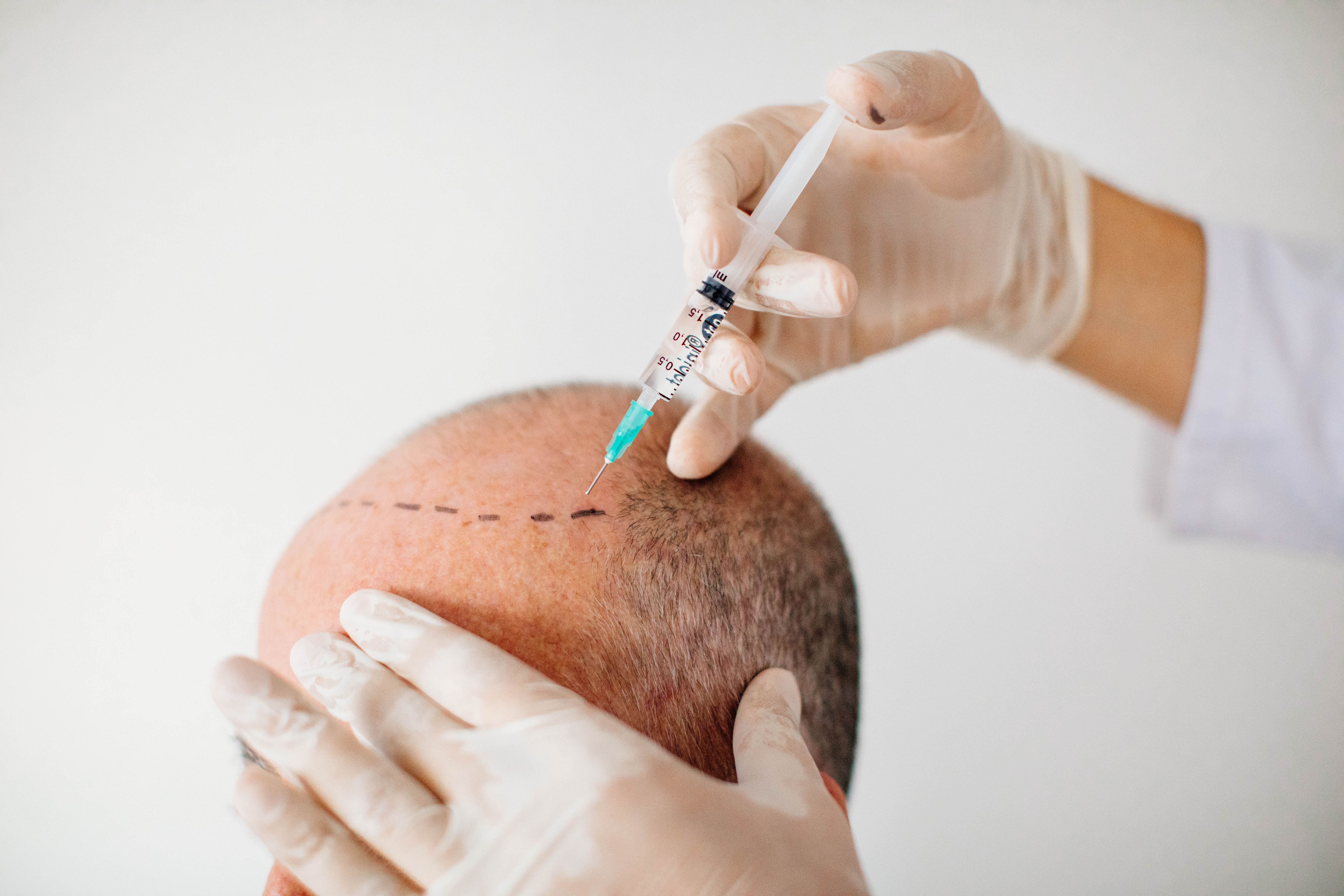 Man with VII Norwood baldness getting ready for hair transplant 
