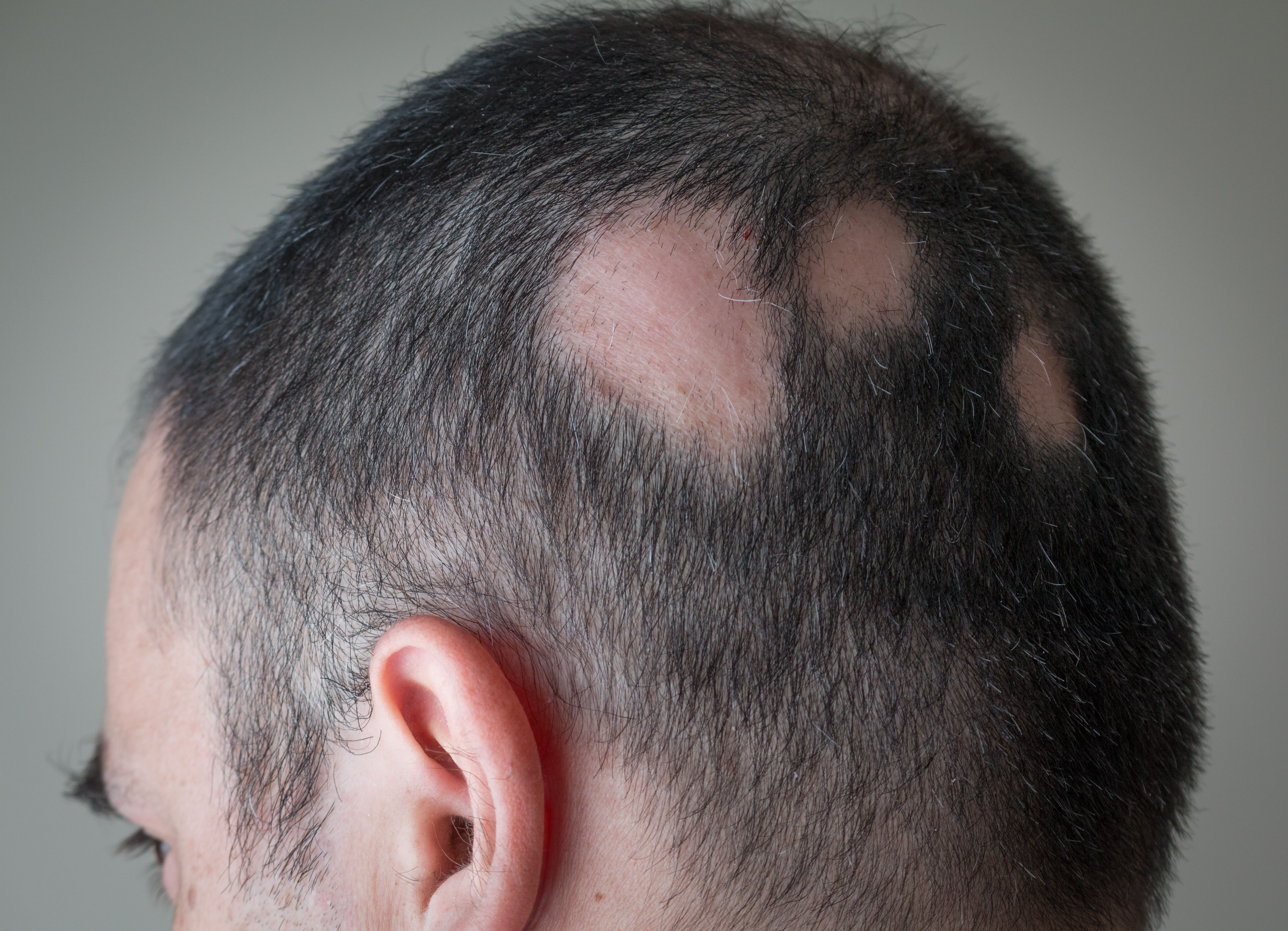 alopecia areata leicester treatment