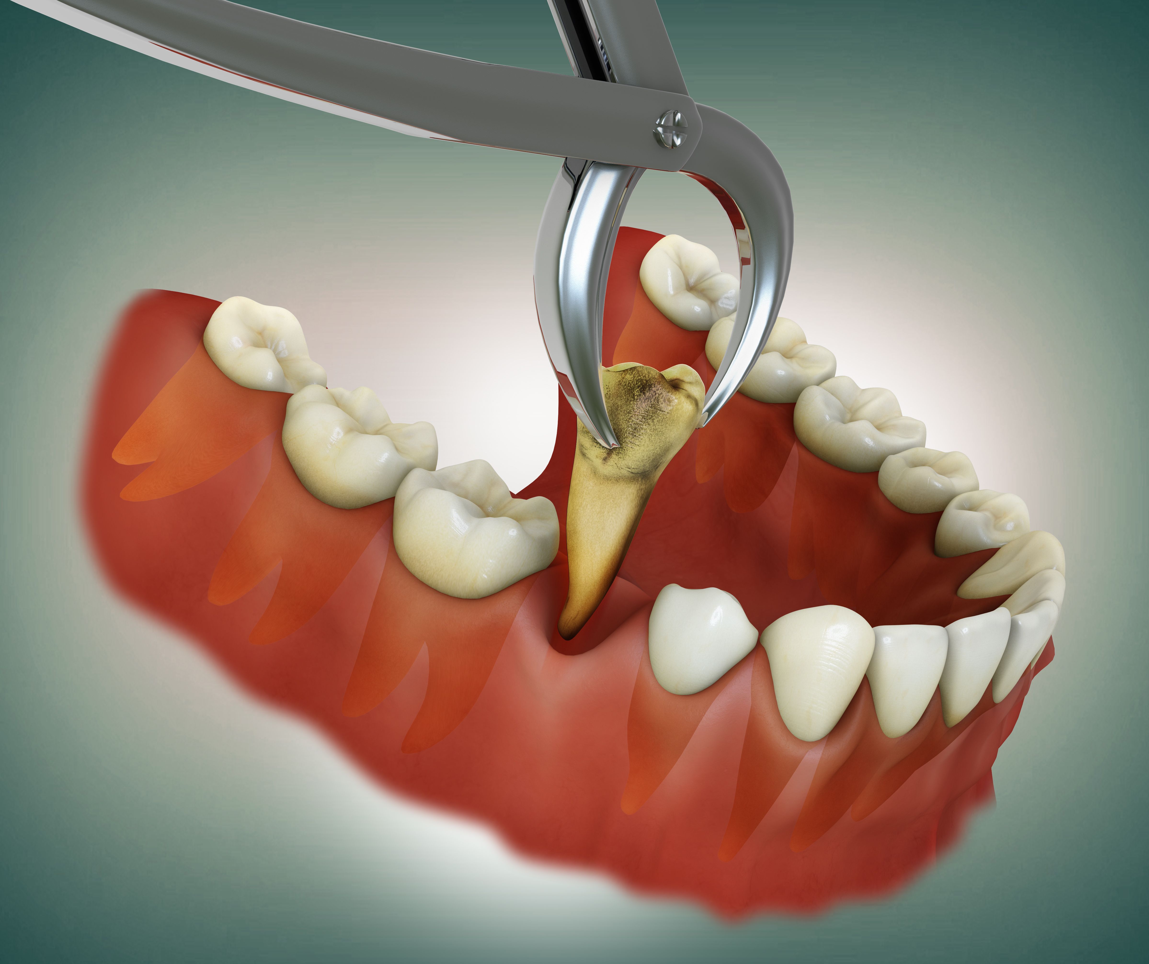 tooth extraction