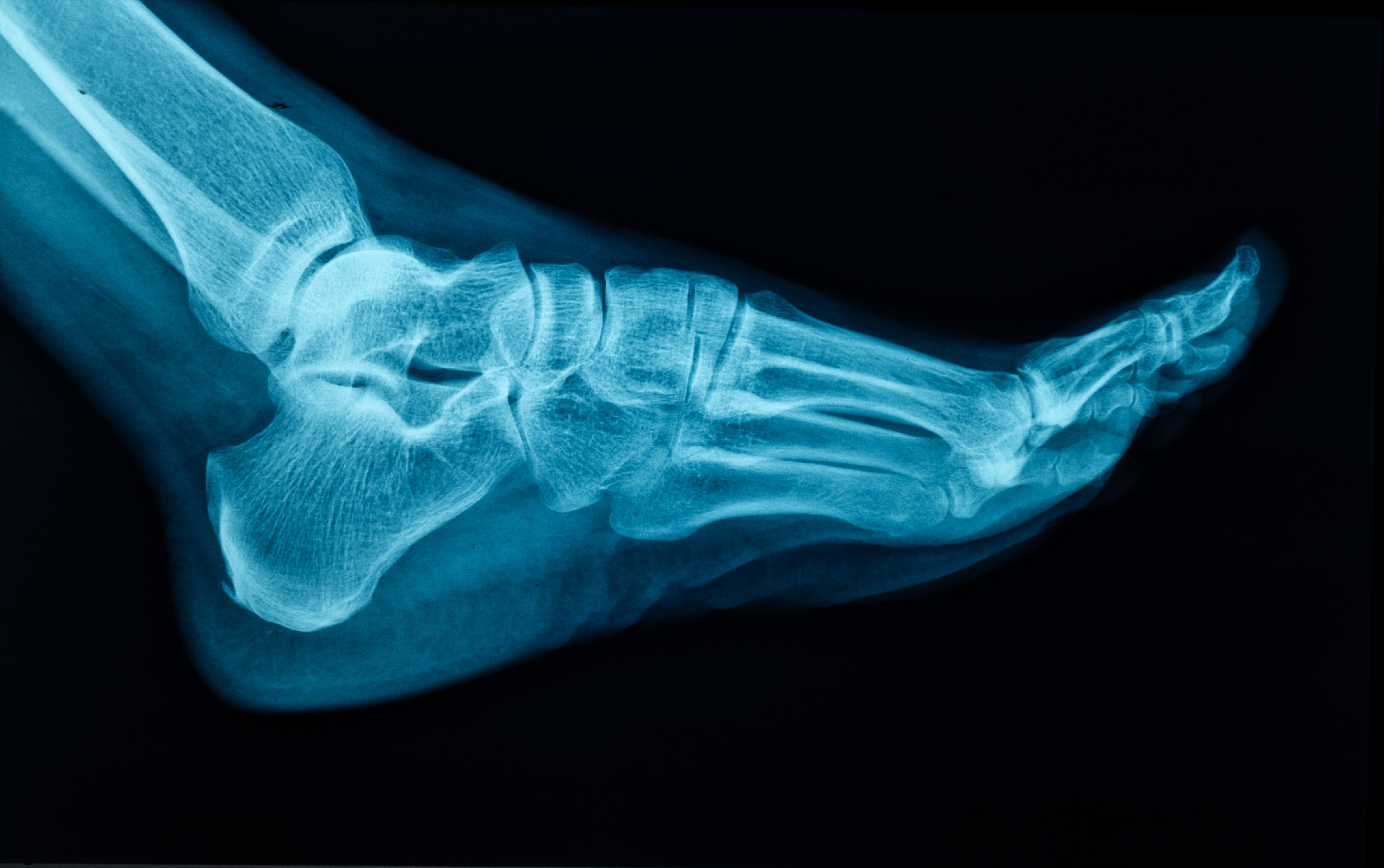 ankle x-ray