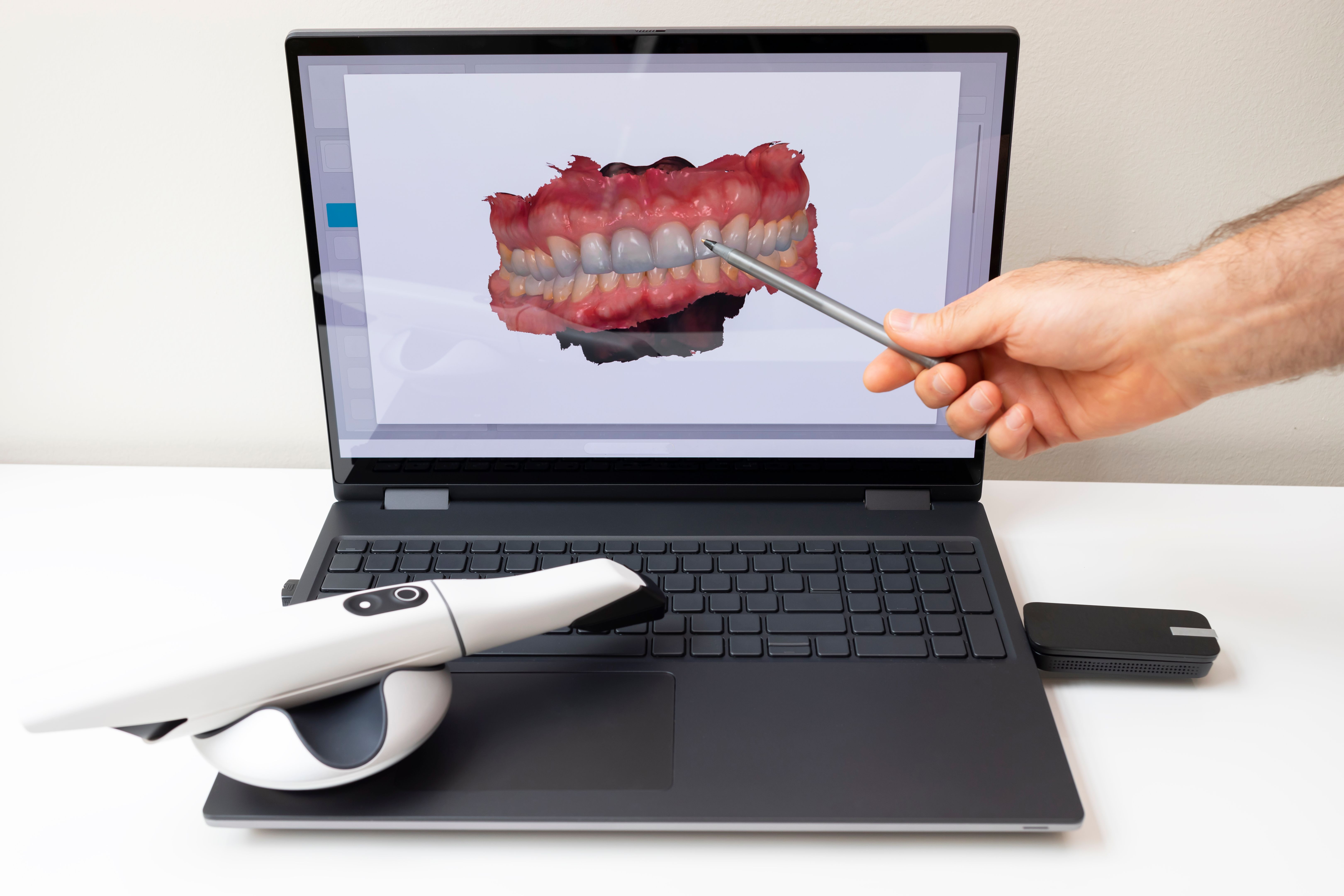 teeth whitening
