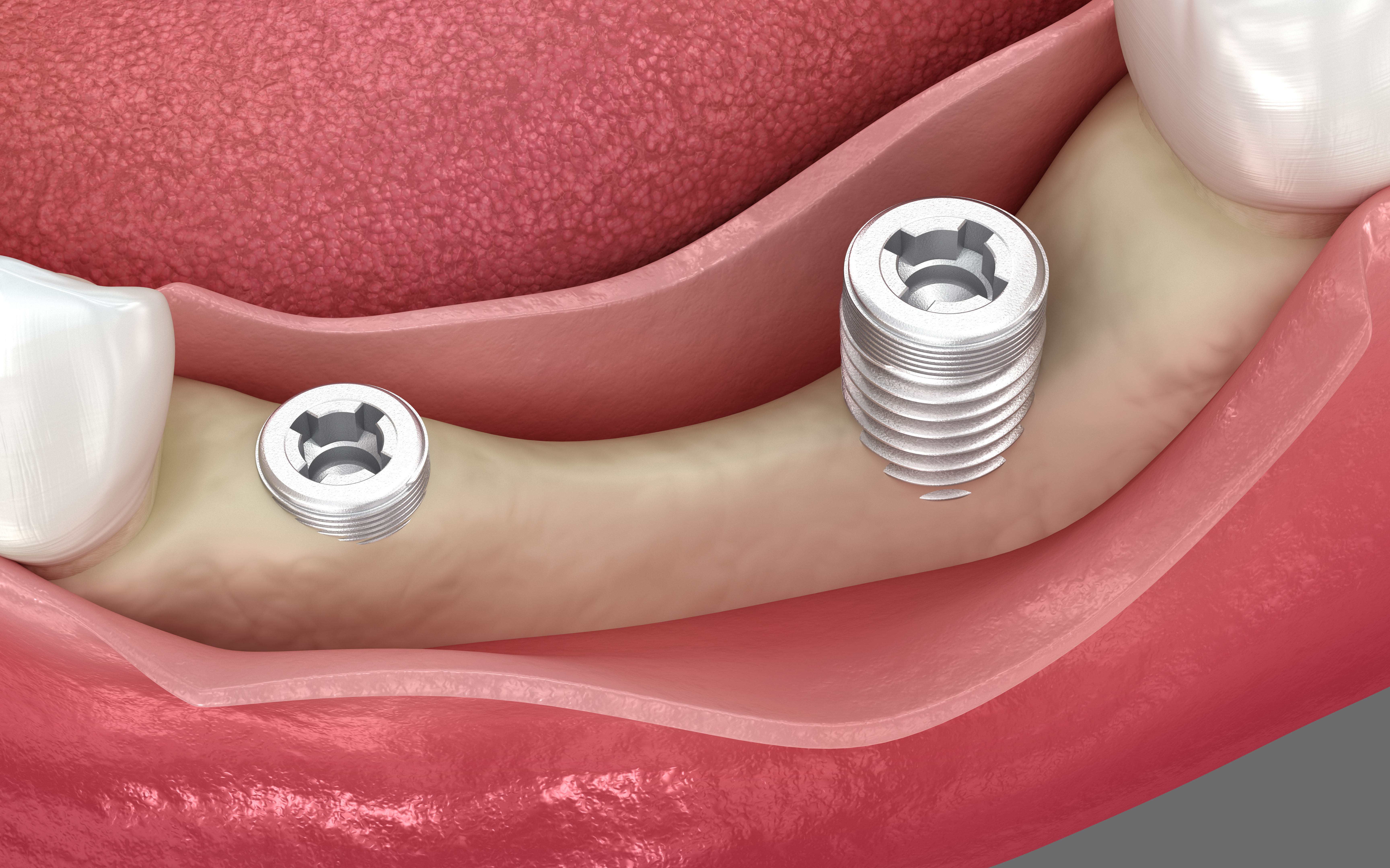 dental implant procedure