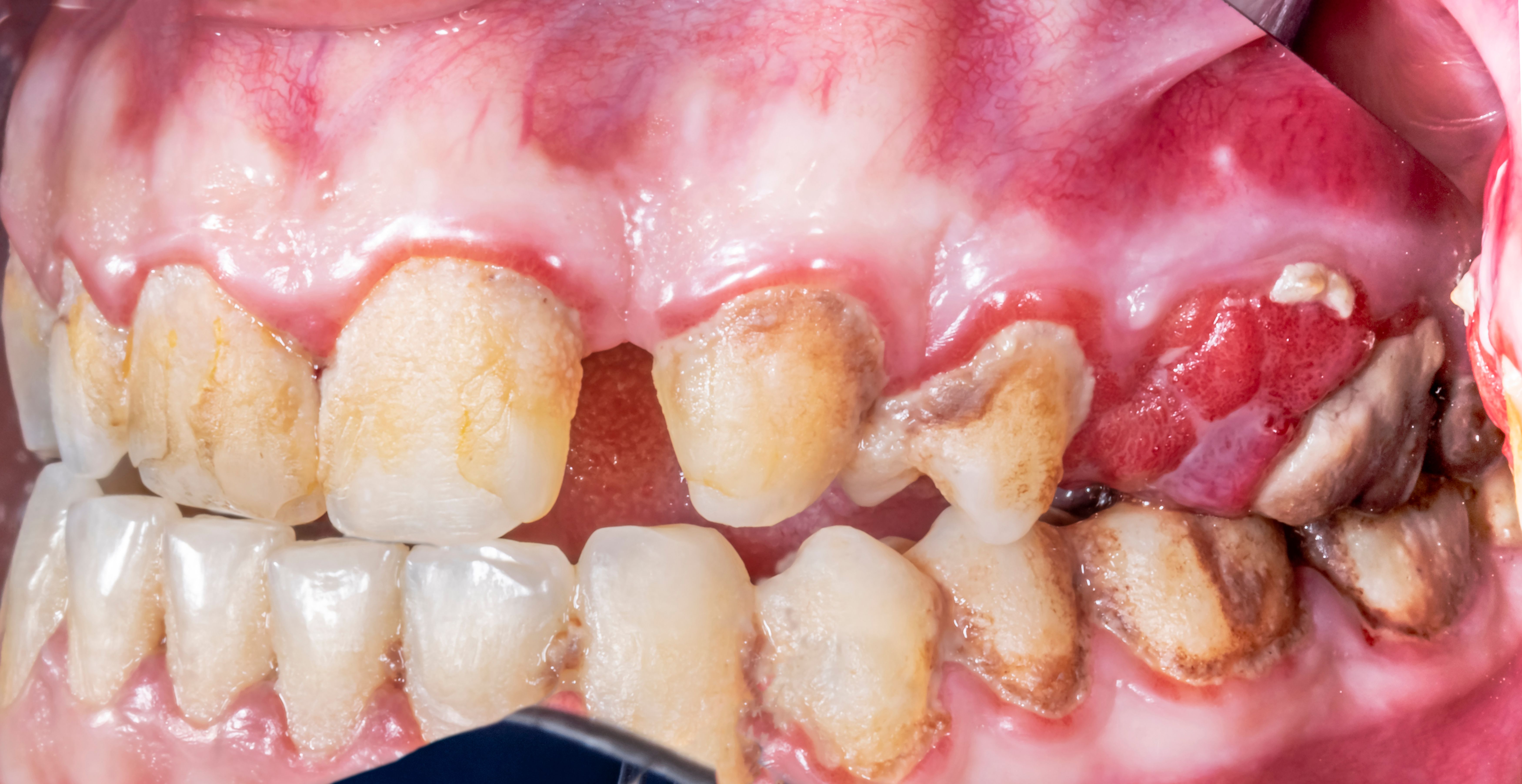 gum disease symptoms