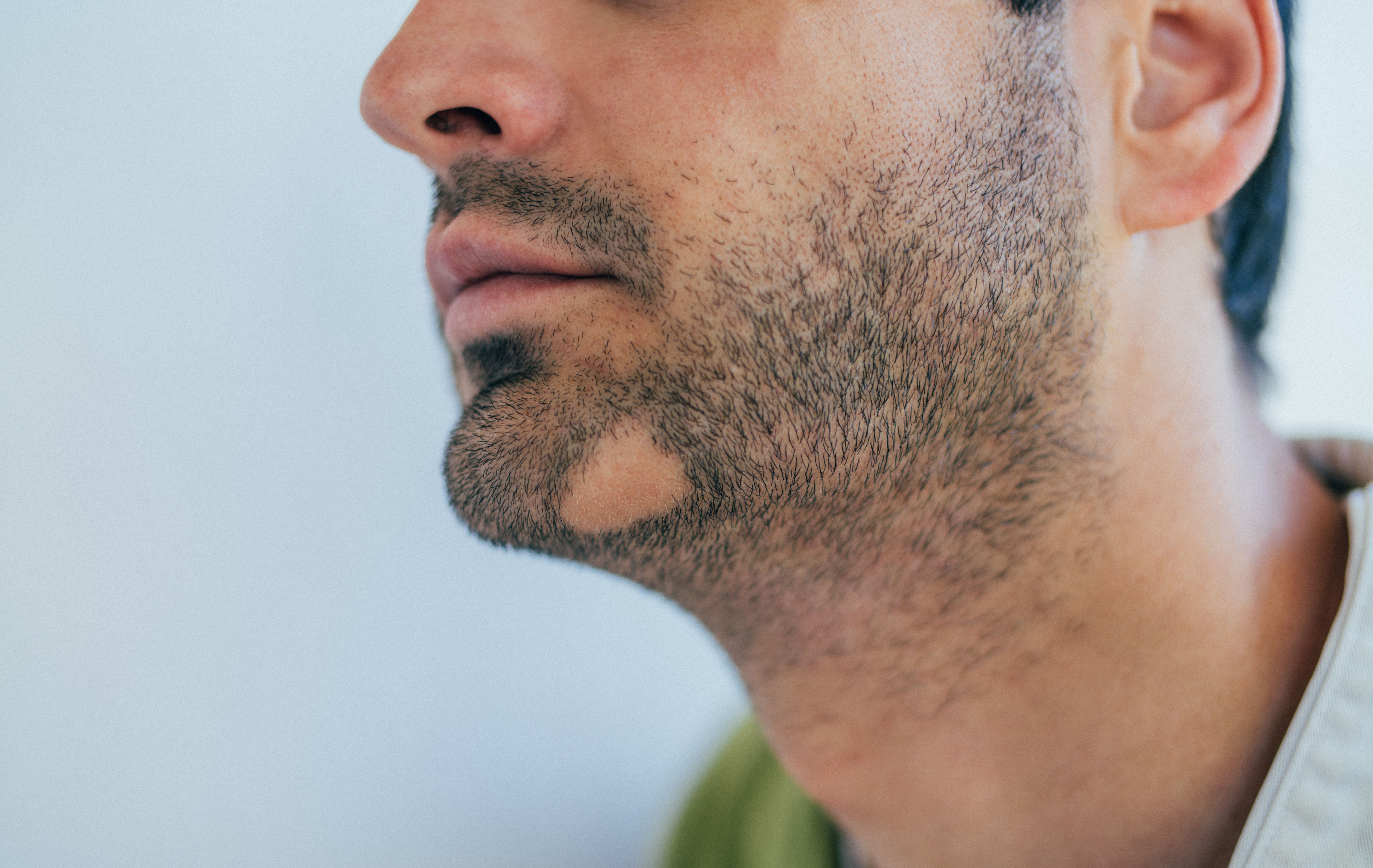 Alopecia areata on beard, hair loss treatment leicester Alopecia areata on beard, hair loss treatment leicester
