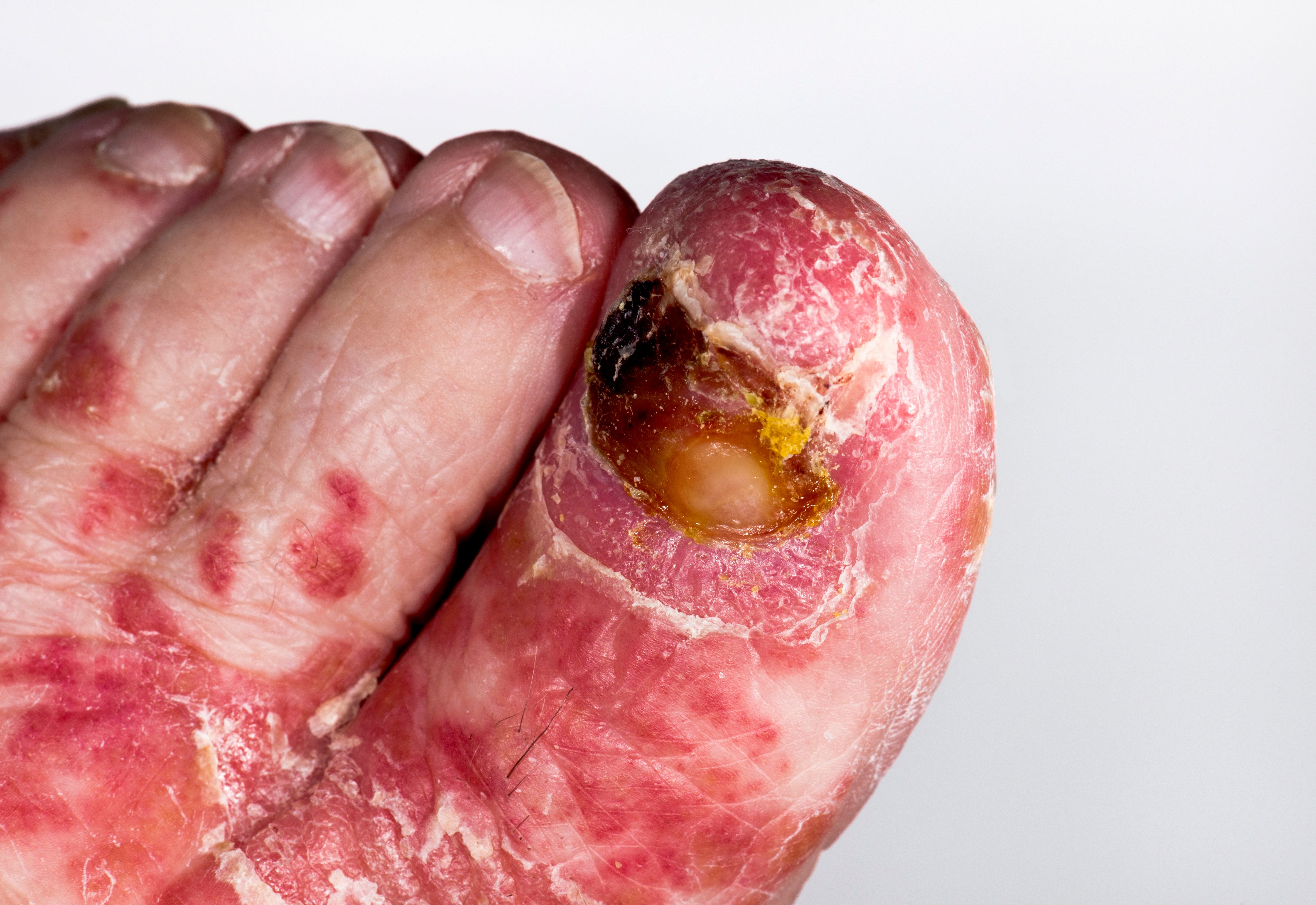 toenail psoriasis