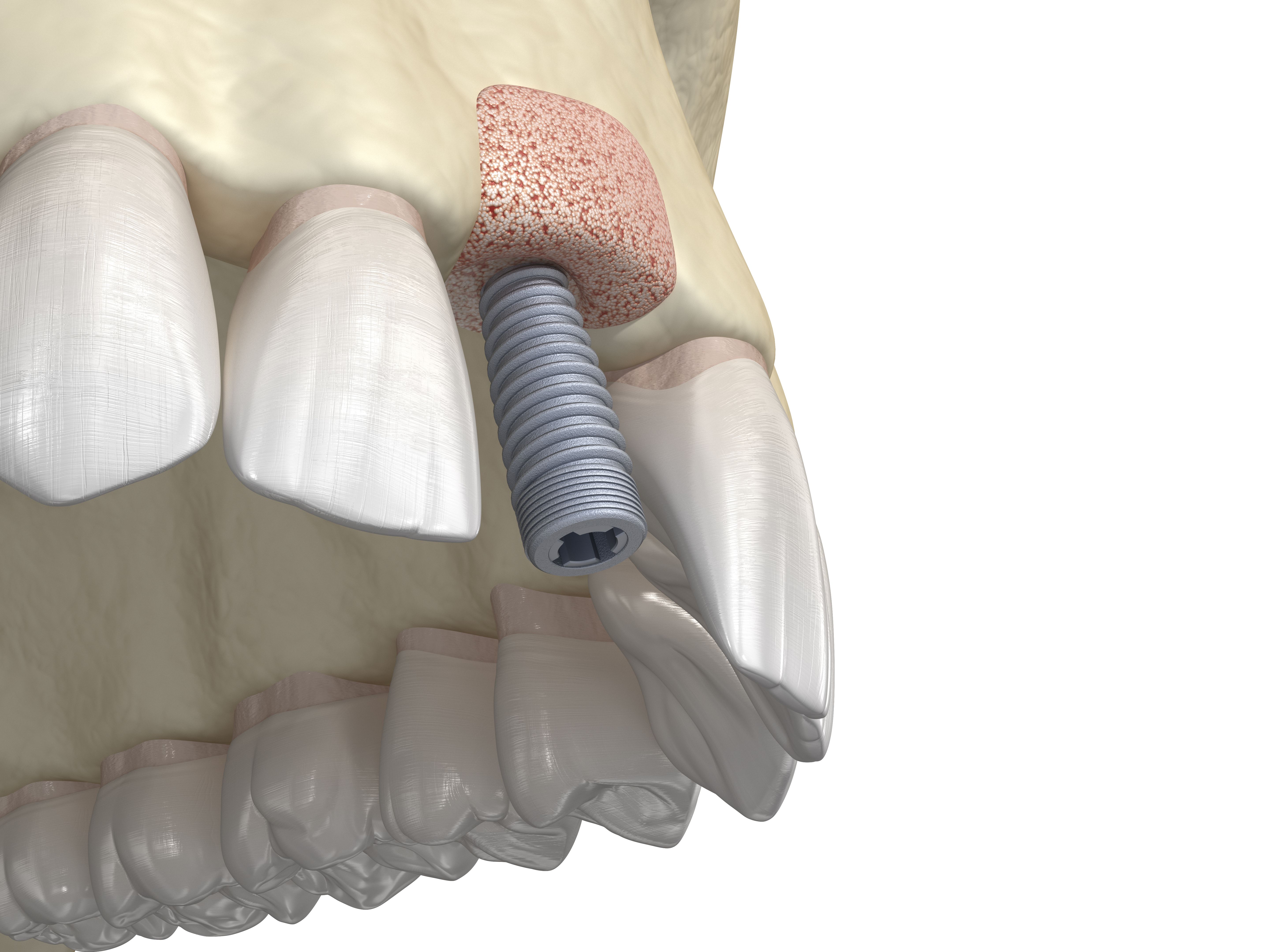 Bone grafting- augmentation using ring method, tooth implantation. Medically accurate 3D illustration