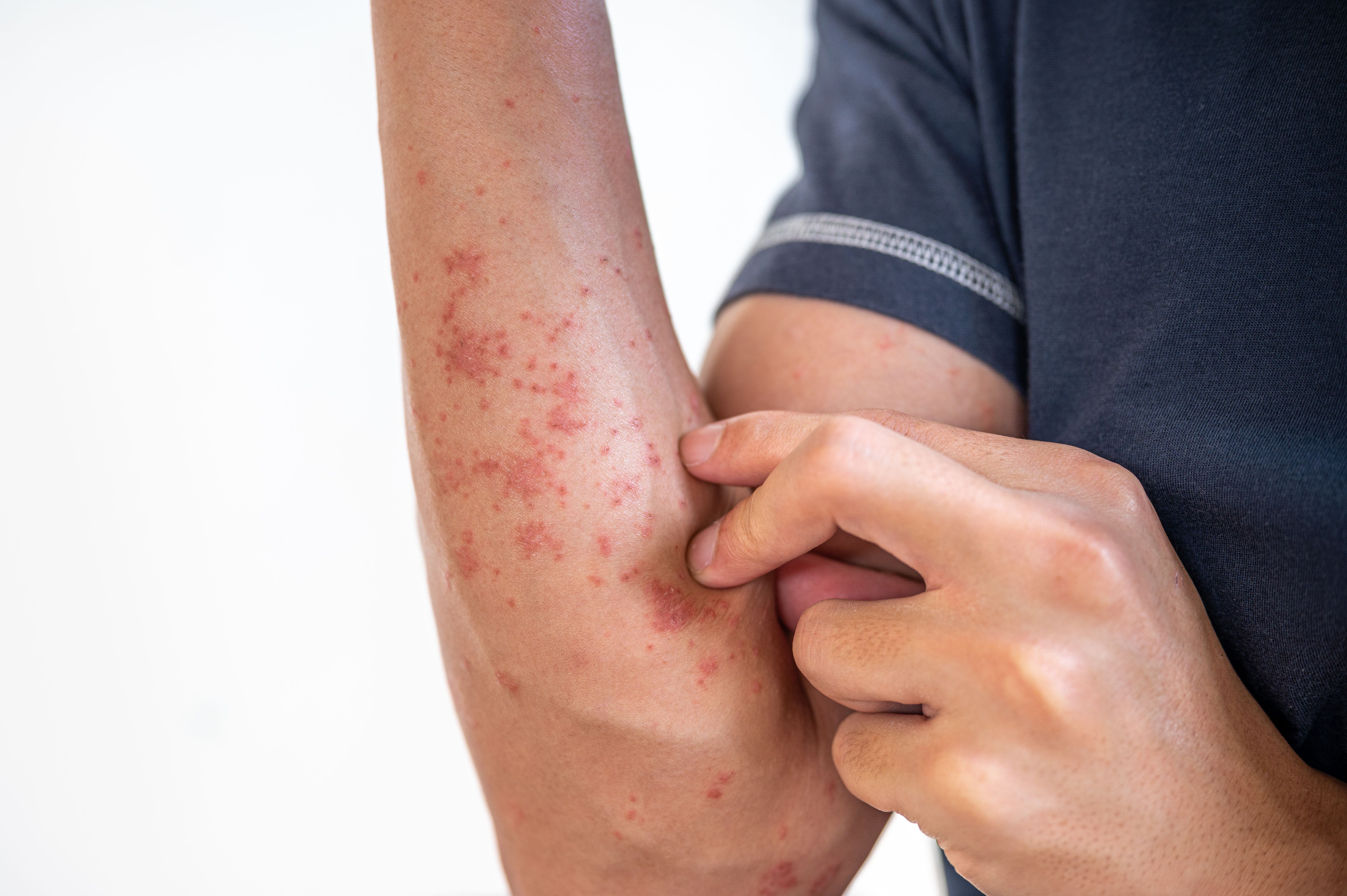 psoriasis triggers