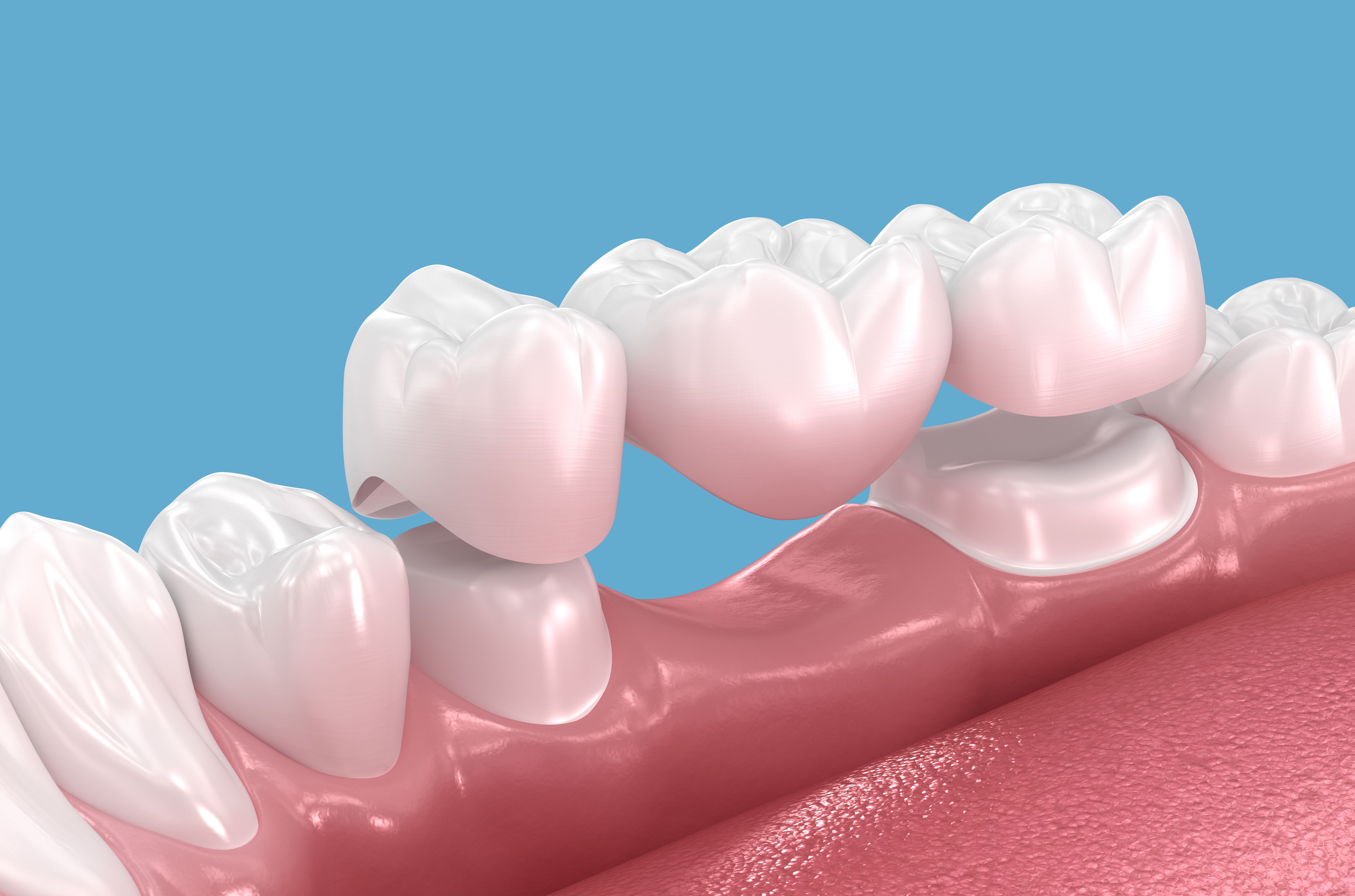 dental bridge