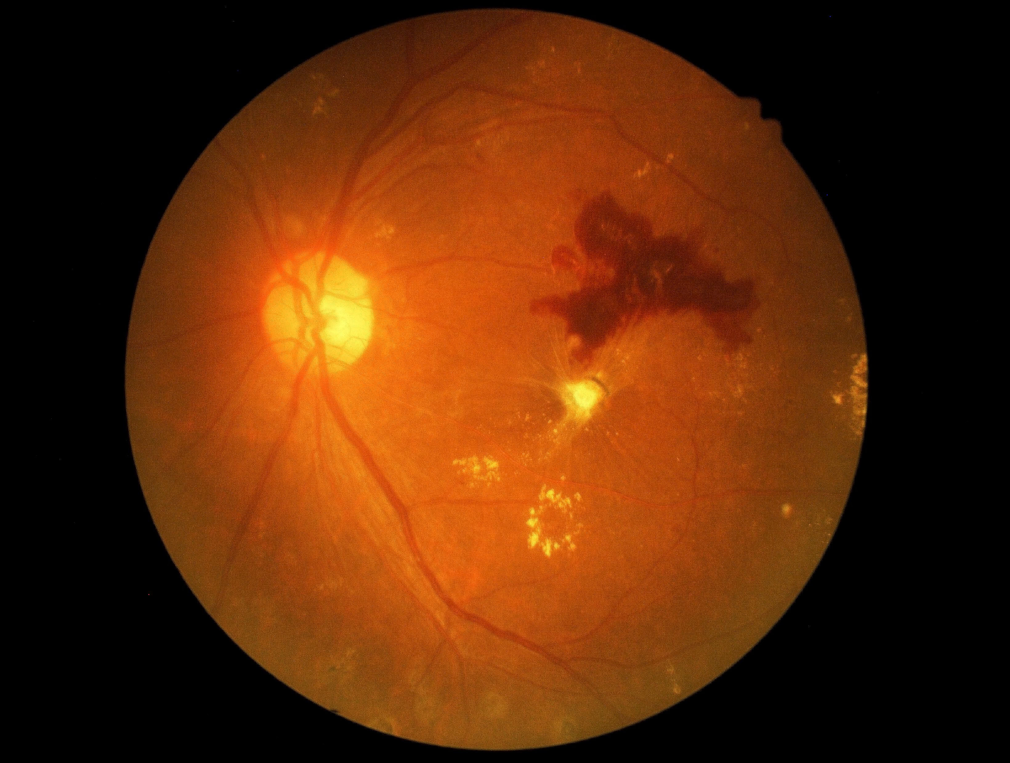 diabetes eye