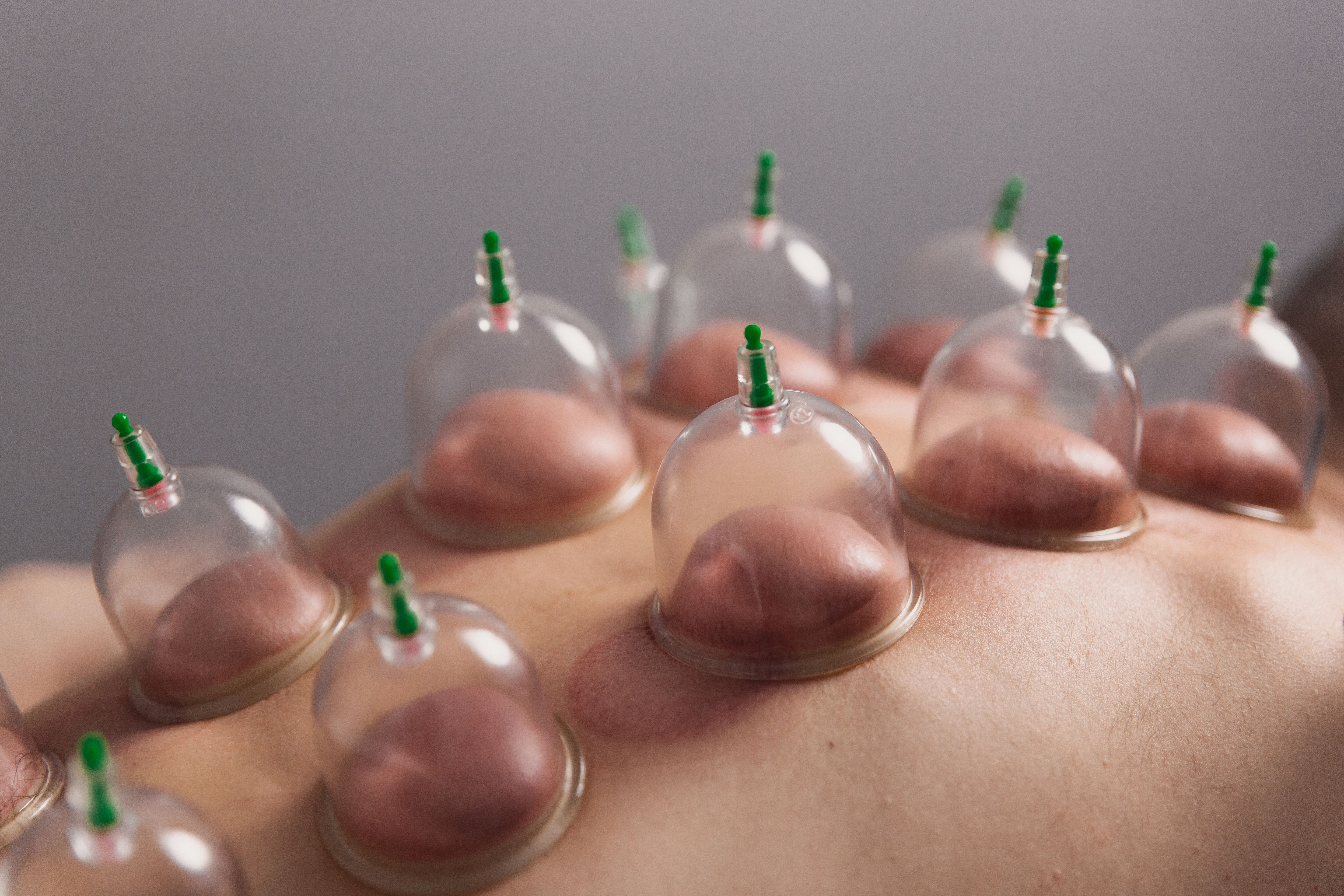 Banks for massage on the man's back. Massage with vacuum cups. Banks for massage on the man's back. Massage with vacuum cups.