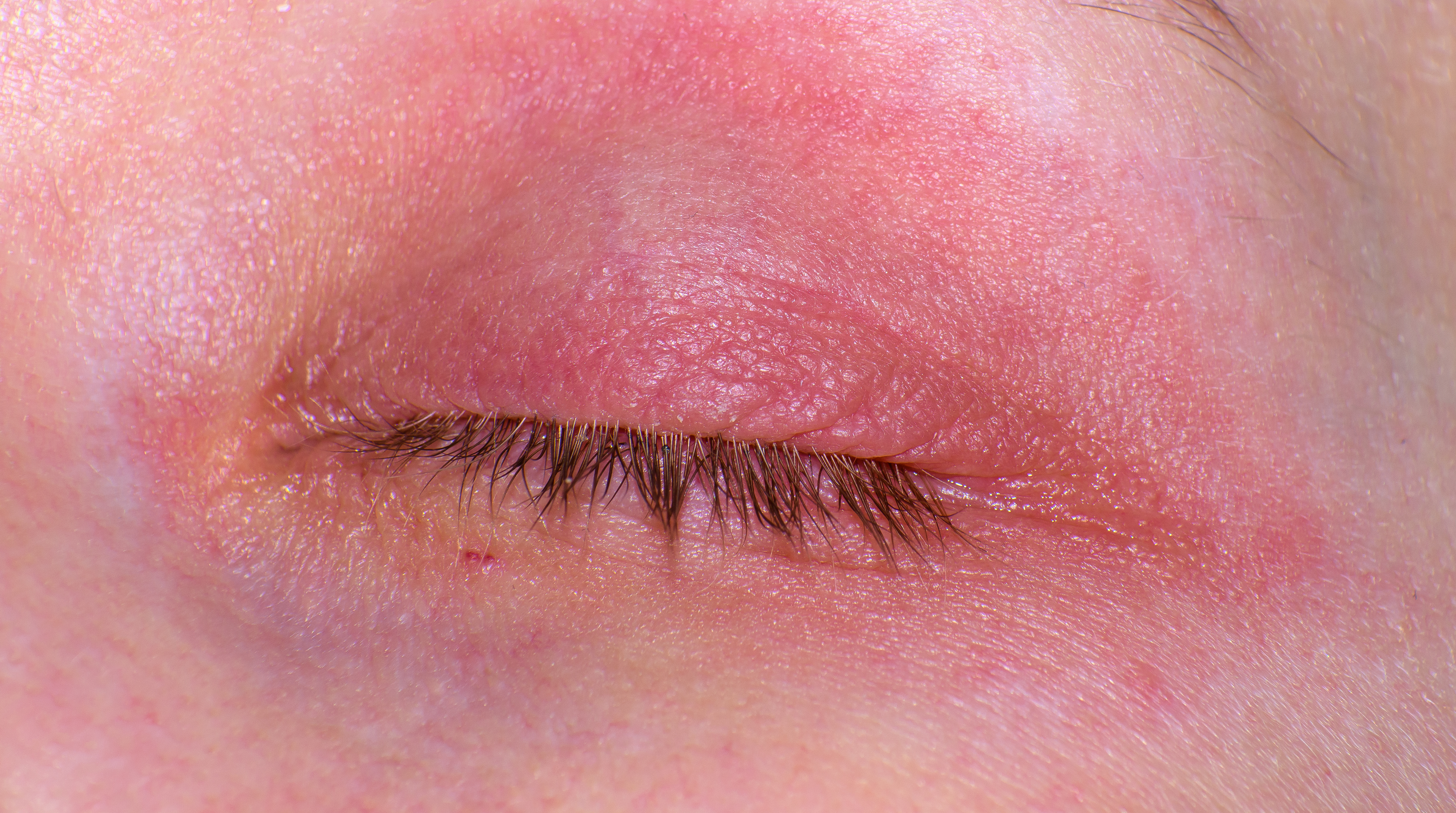 דלקת עור ממגע בעפעפיים: גורמים, תסמינים וטיפול דלקת עור ממגע בעפעפיים: גורמים, תסמינים וטיפול