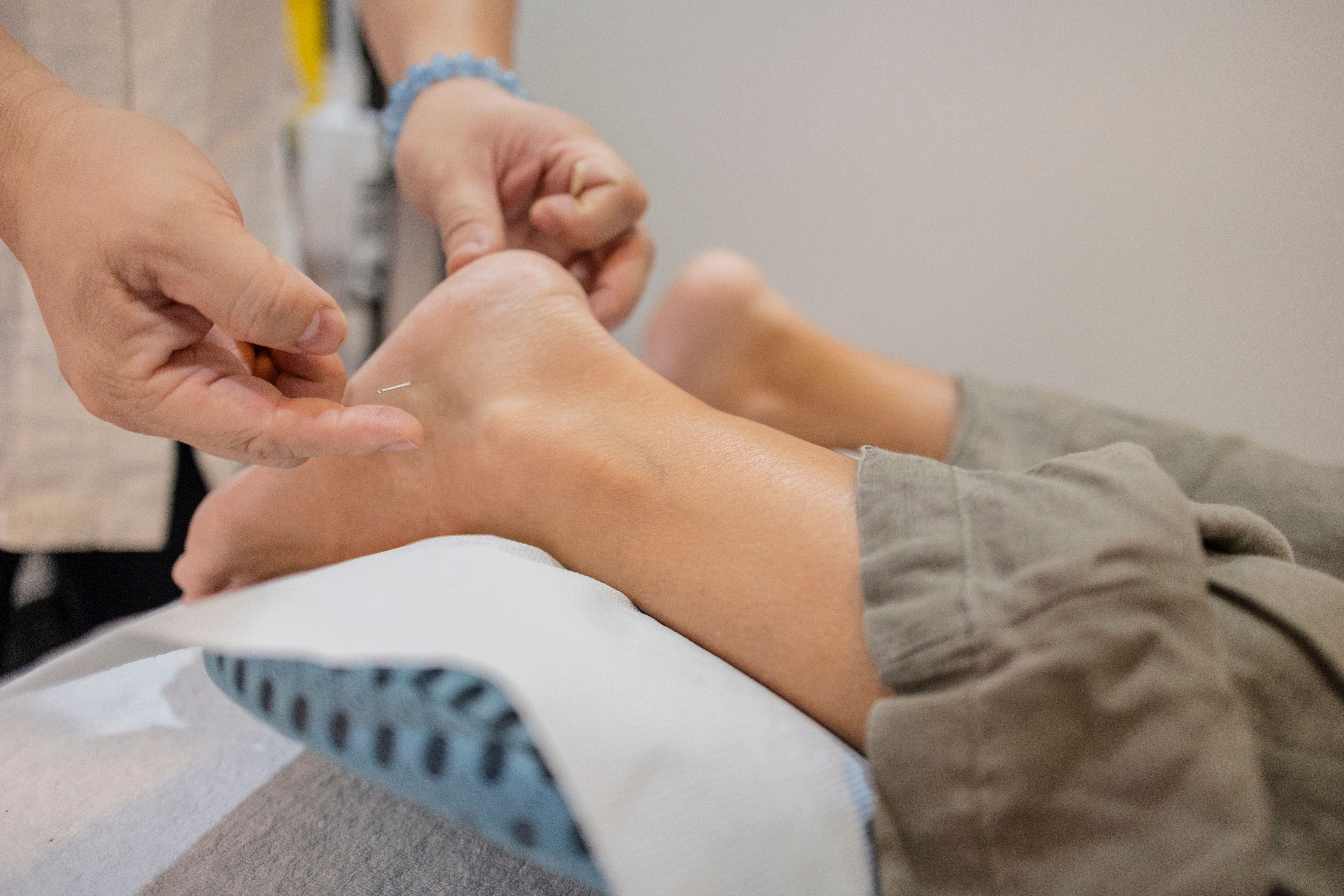 relaxing acupuncture