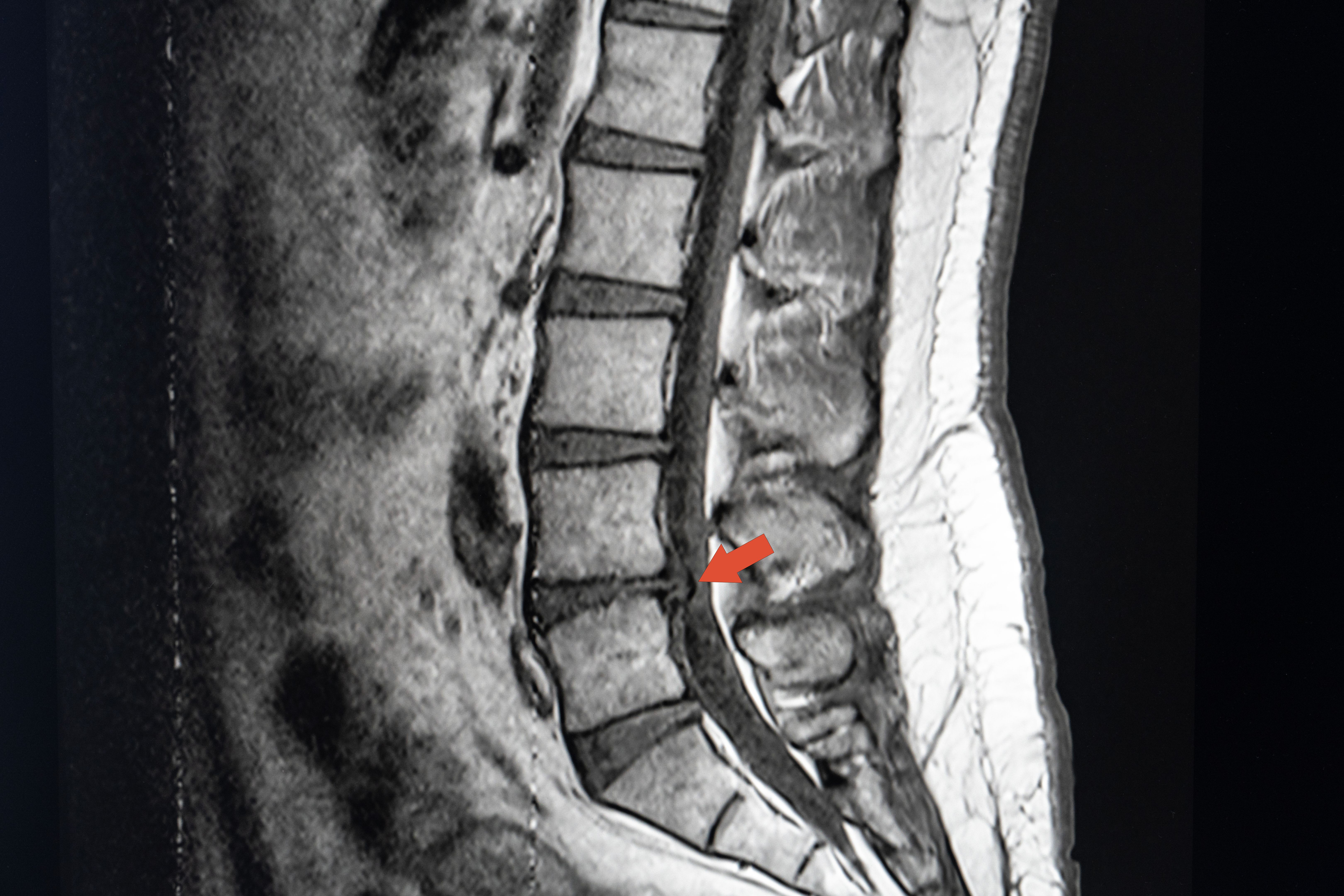 MRI scan of lateral lumbar vertebral column showing L4-L5 disc herniation.