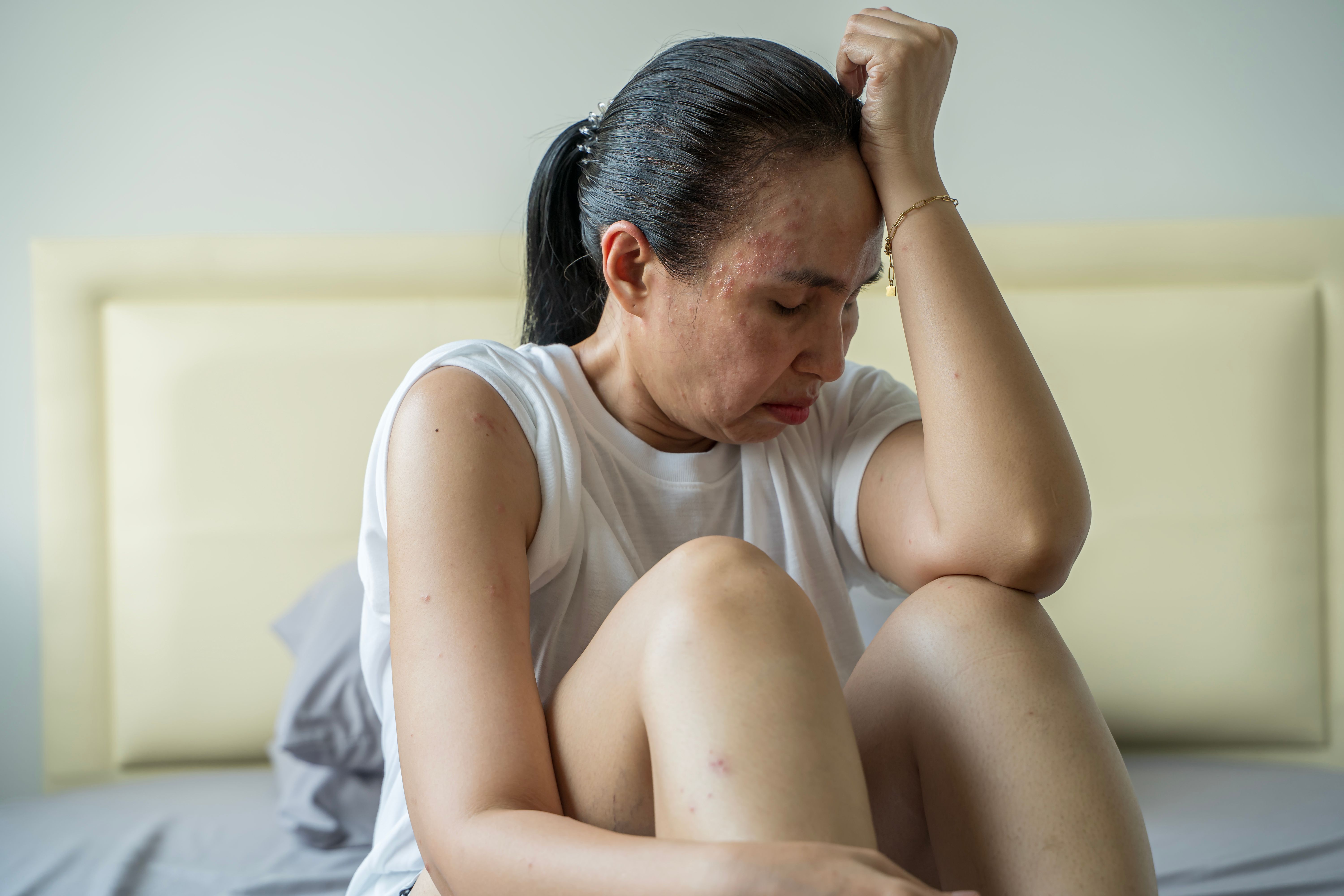 Pale young woman sitting on a bed, struggling with allergy symptoms. Beautiful attractive girl lying on bed