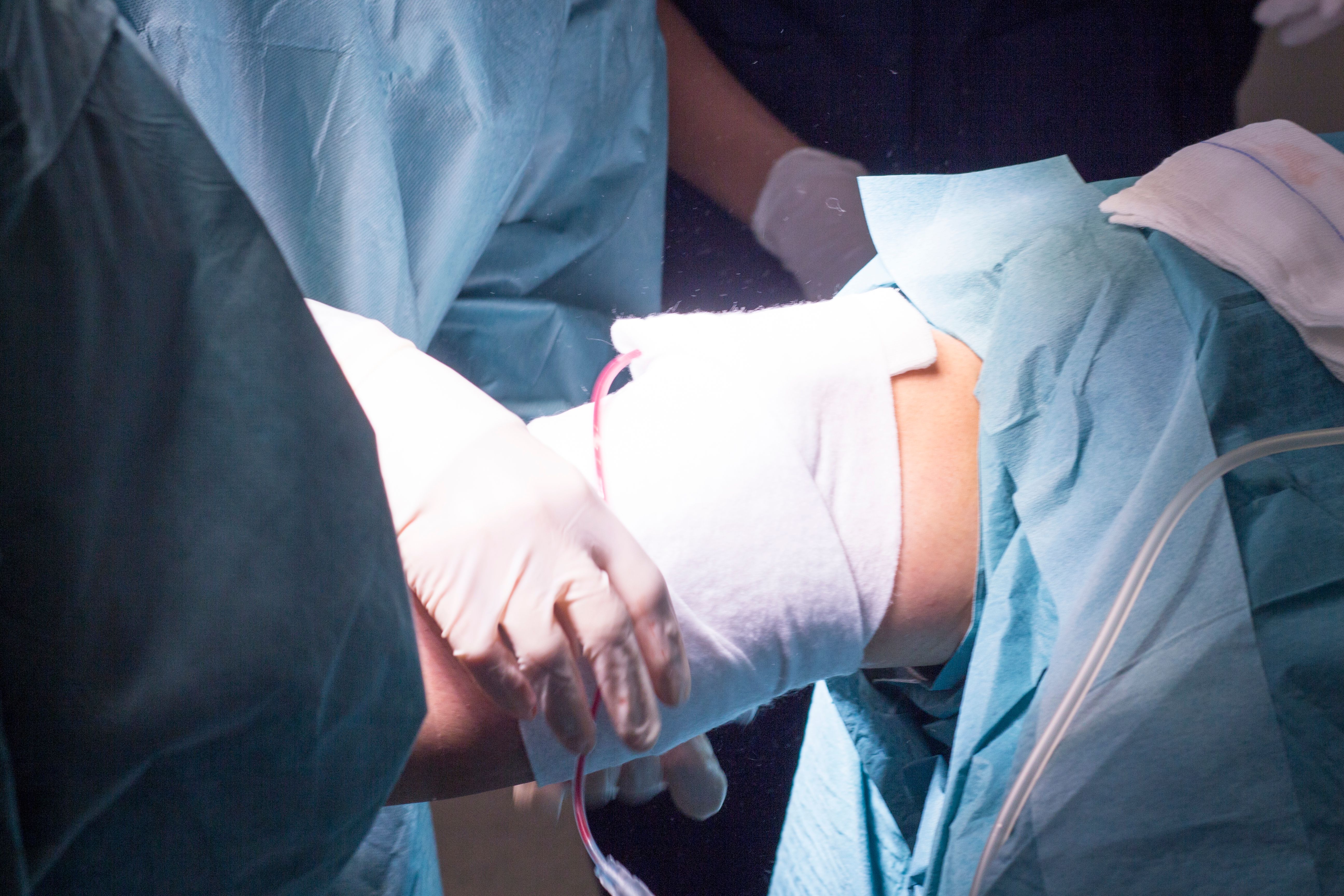endosleeve procedure