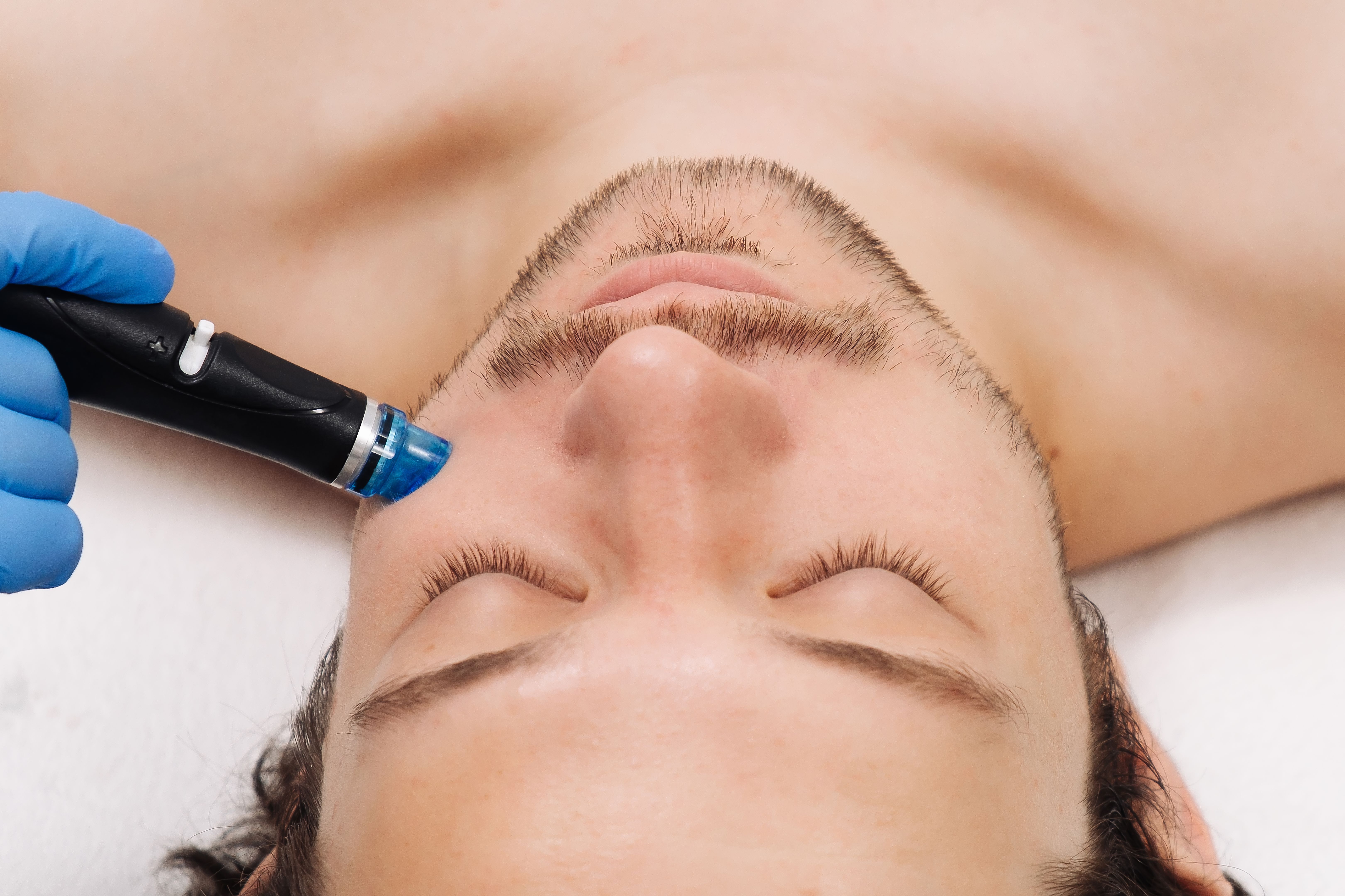 dermaplaning procedure