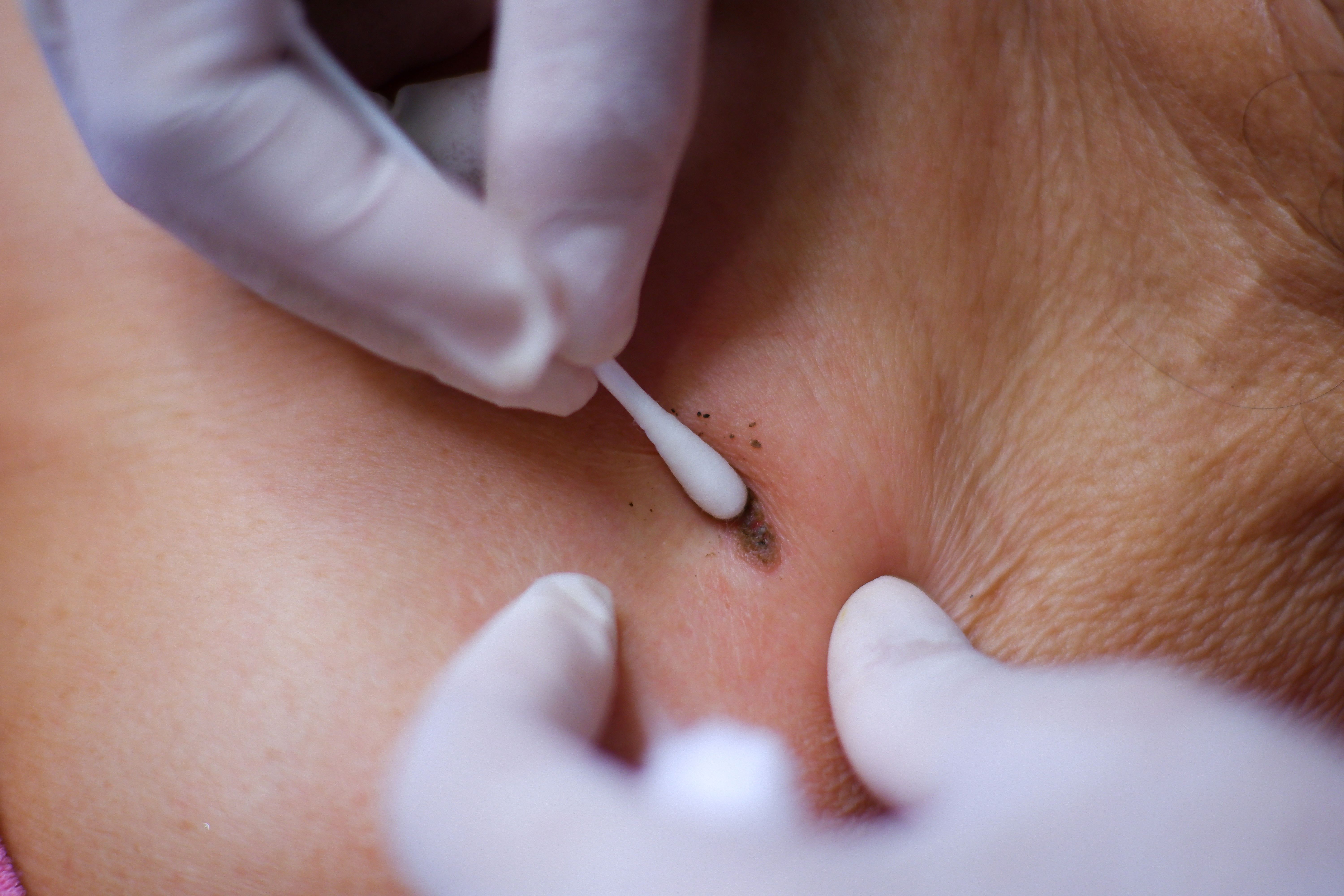 dermatologist consultation