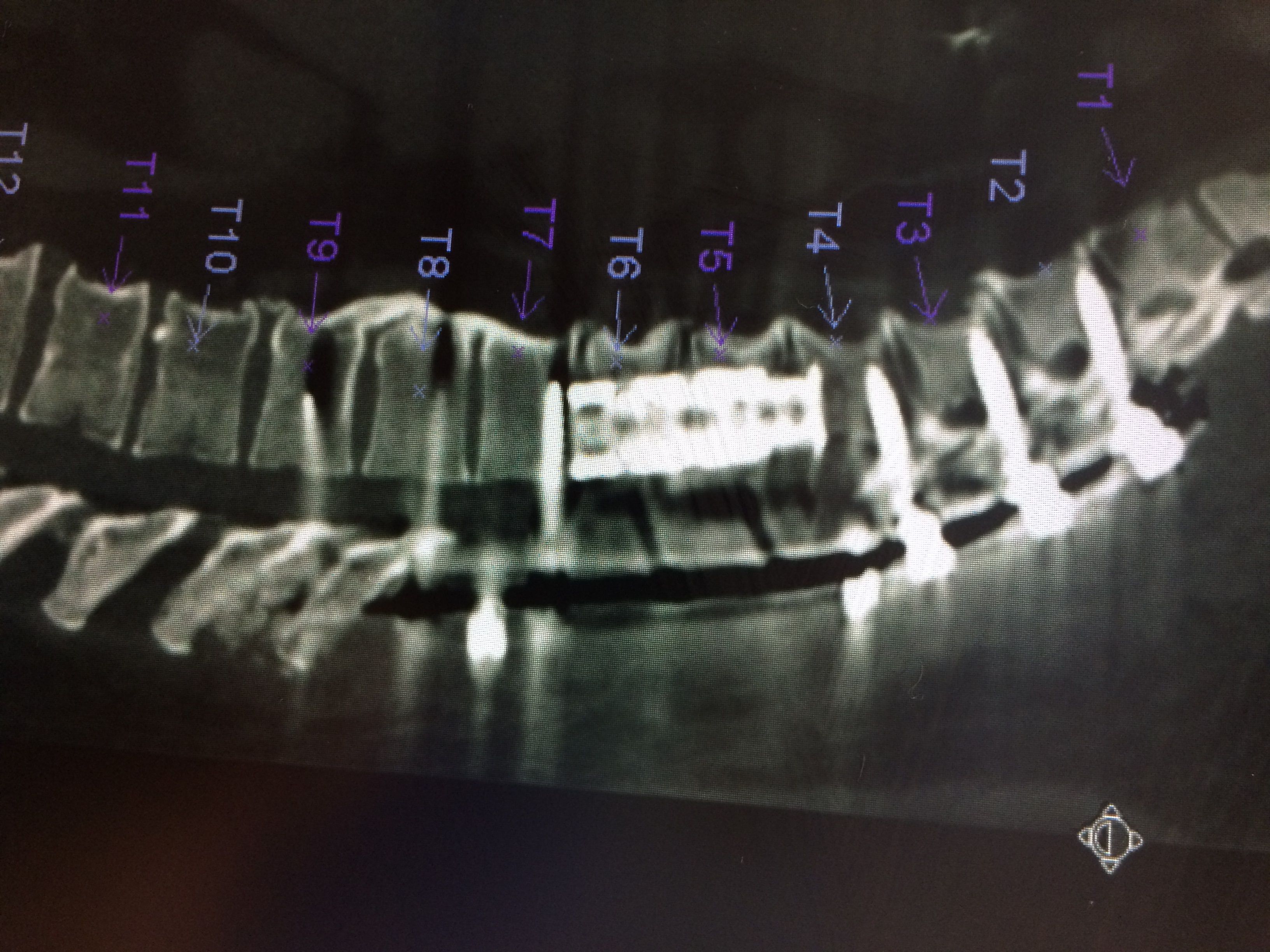 spinal decompression