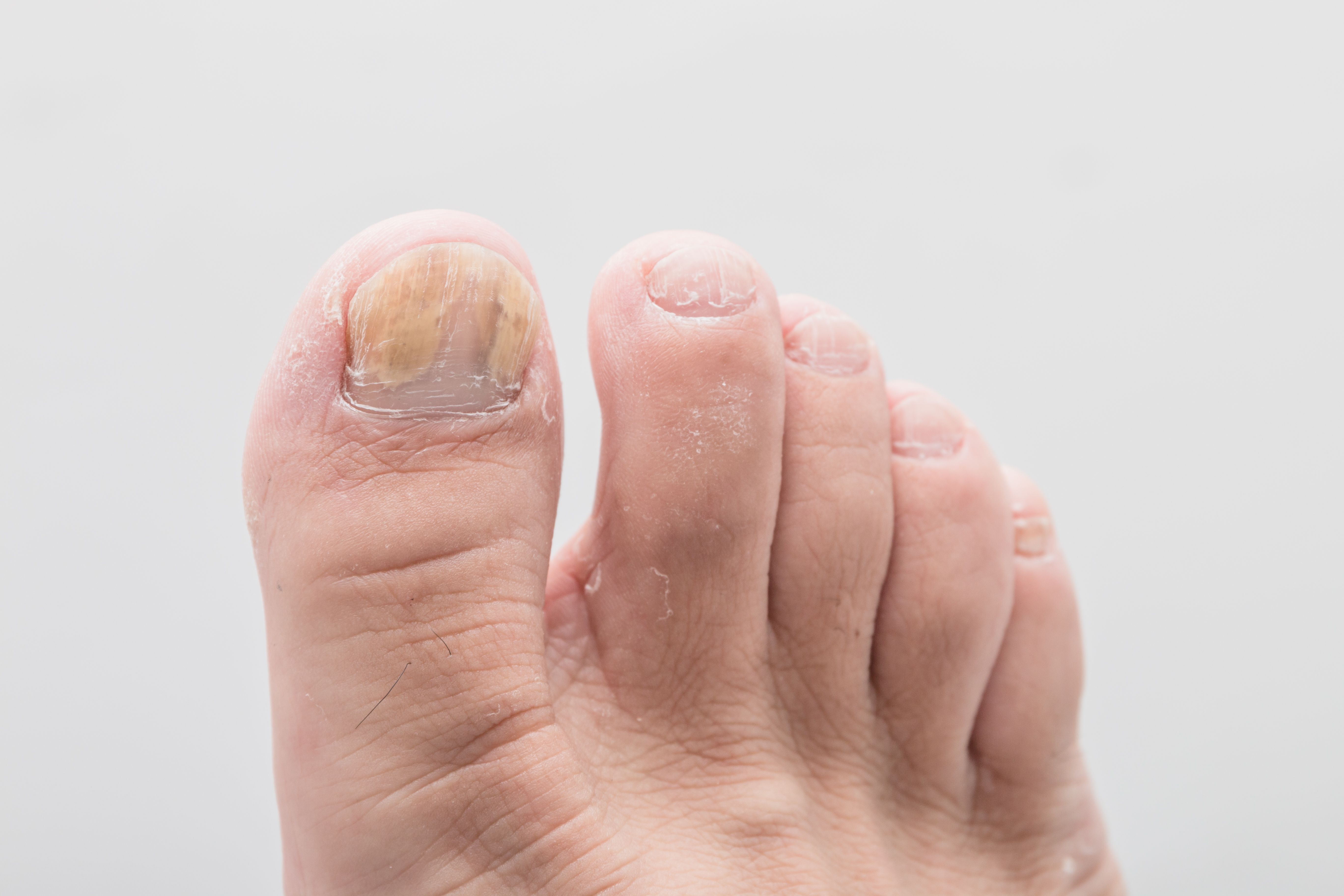 toenail psoriasis