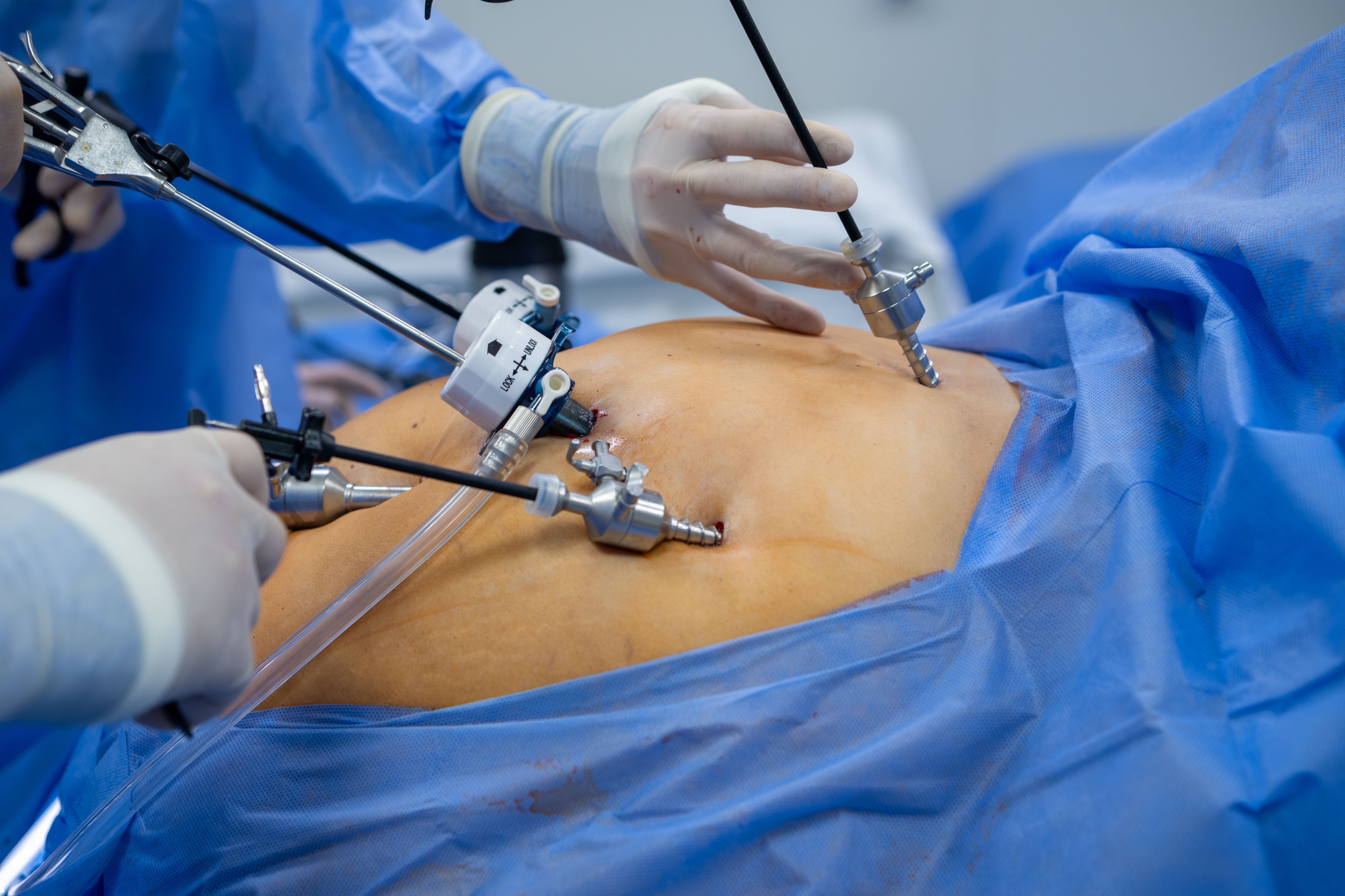 Laparoscopic surgery. The doctor's hand using a special medical instrument. Laparoscopic surgery. The doctor's hand using a special medical instrument.
