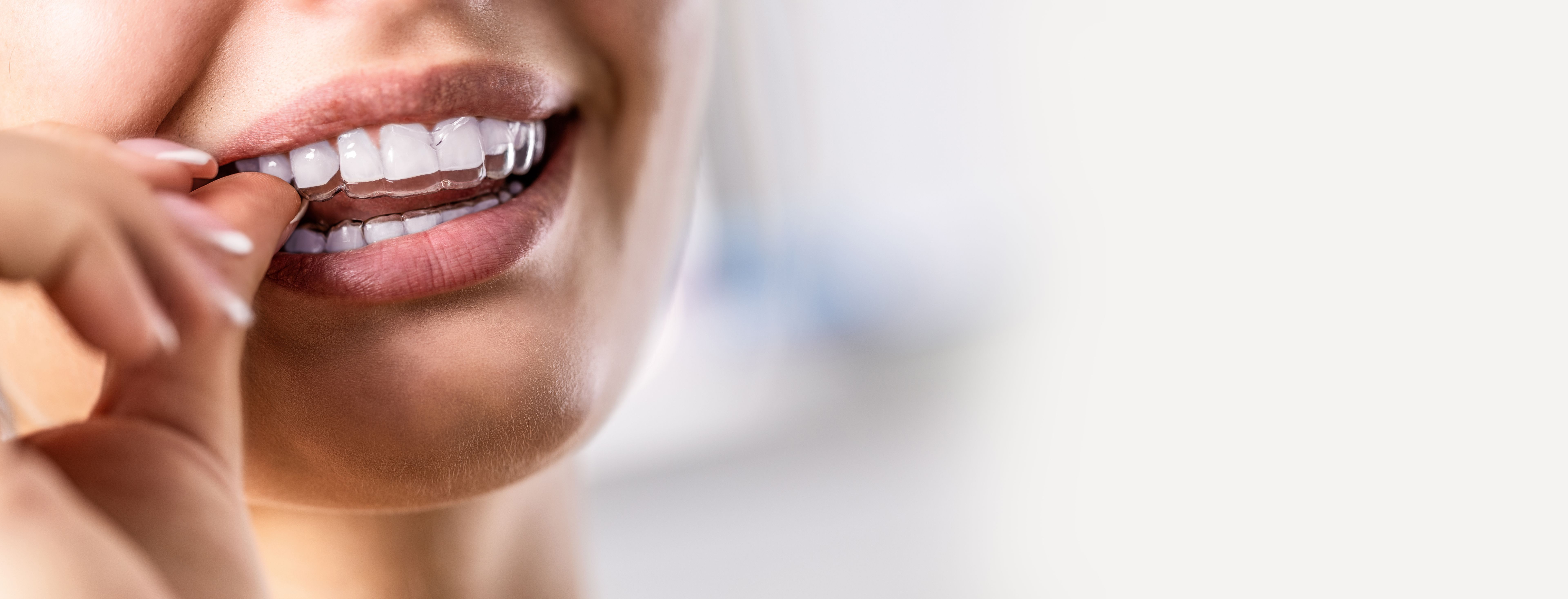 Invisalign Day en CRD: el 12 de marzo te hacemos tu estudio Invisalign ...