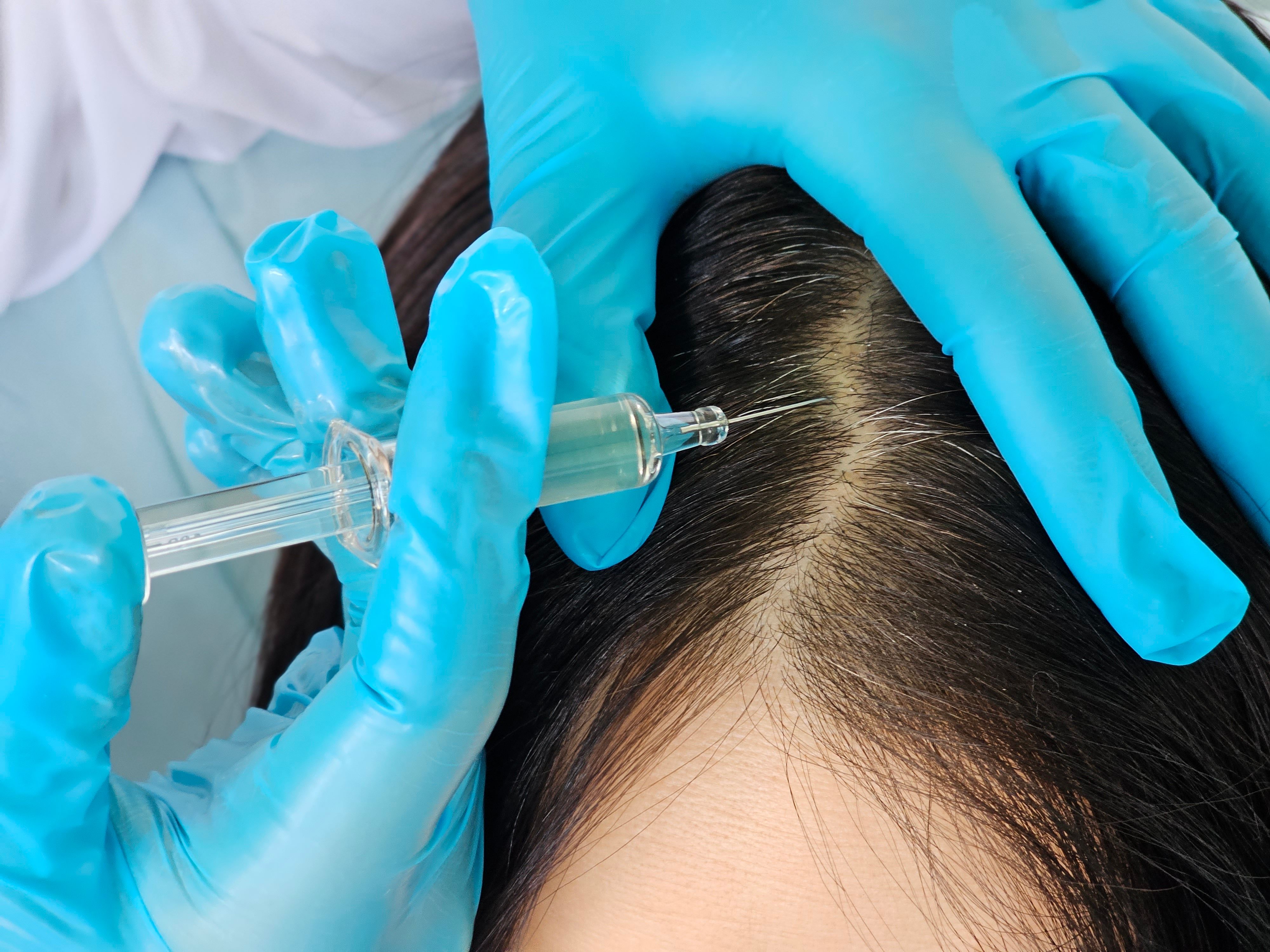 Prp hair loss leicester scalp massage Prp hair loss leicester scalp massage