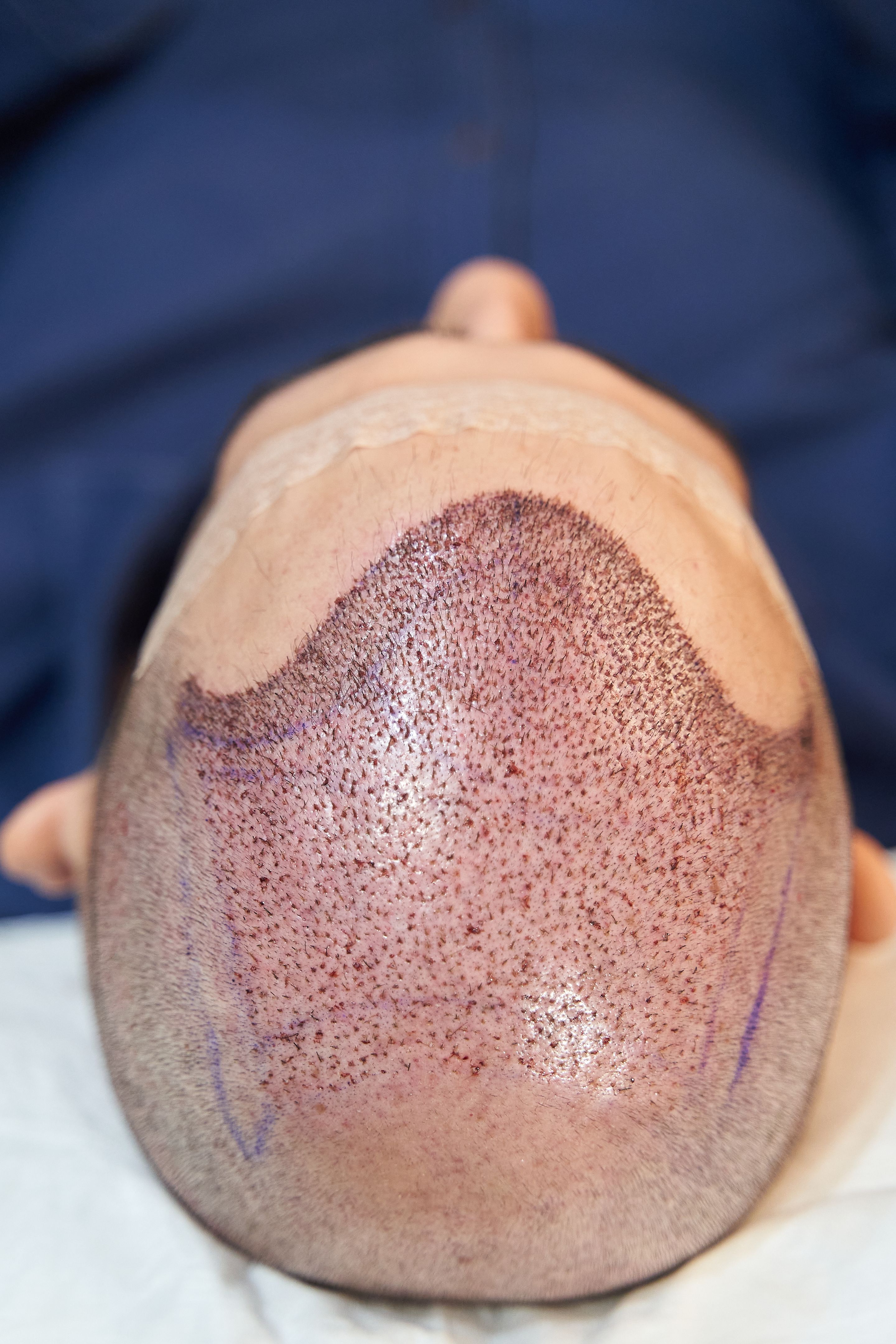 before after hair transplant