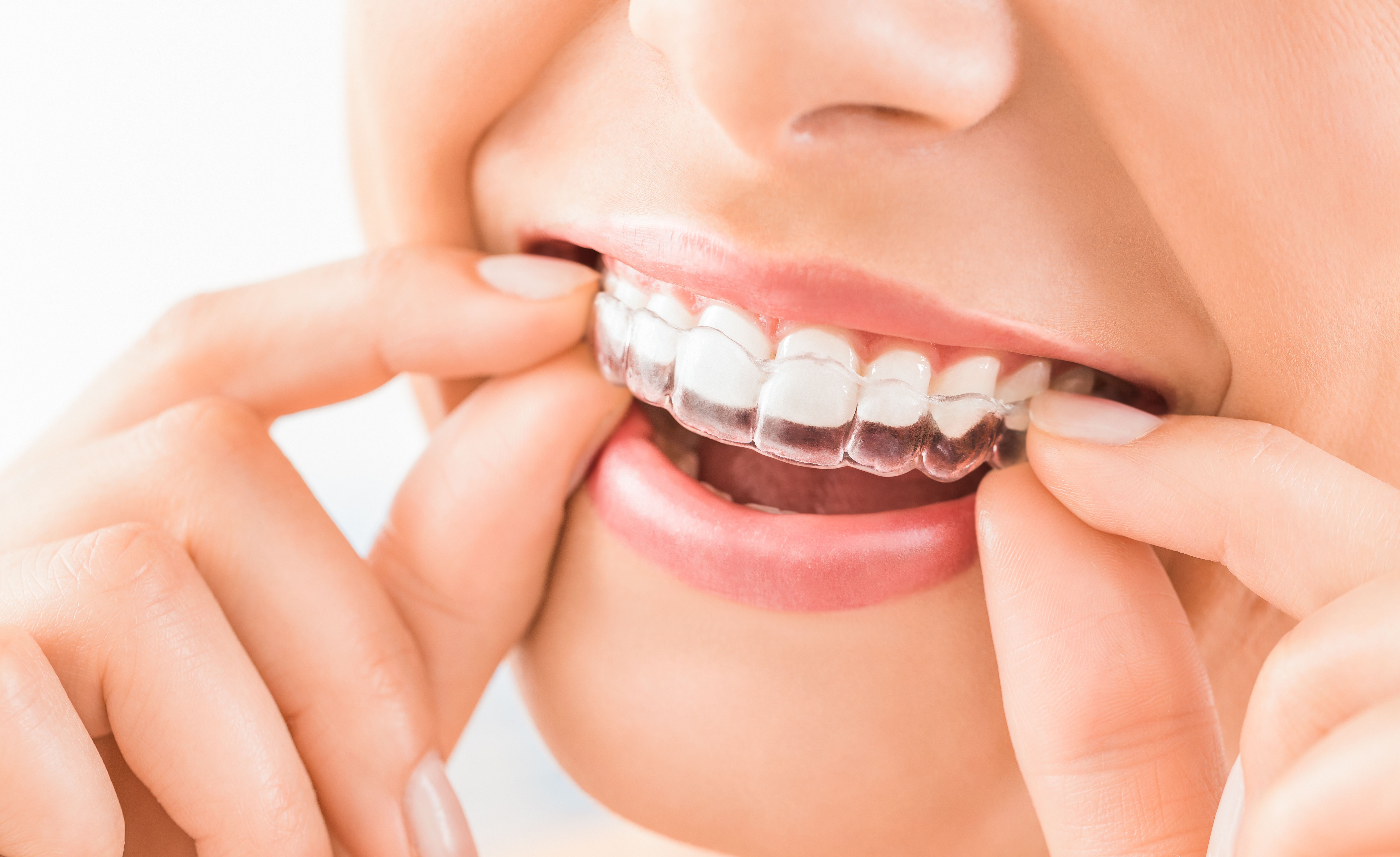 invisible braces