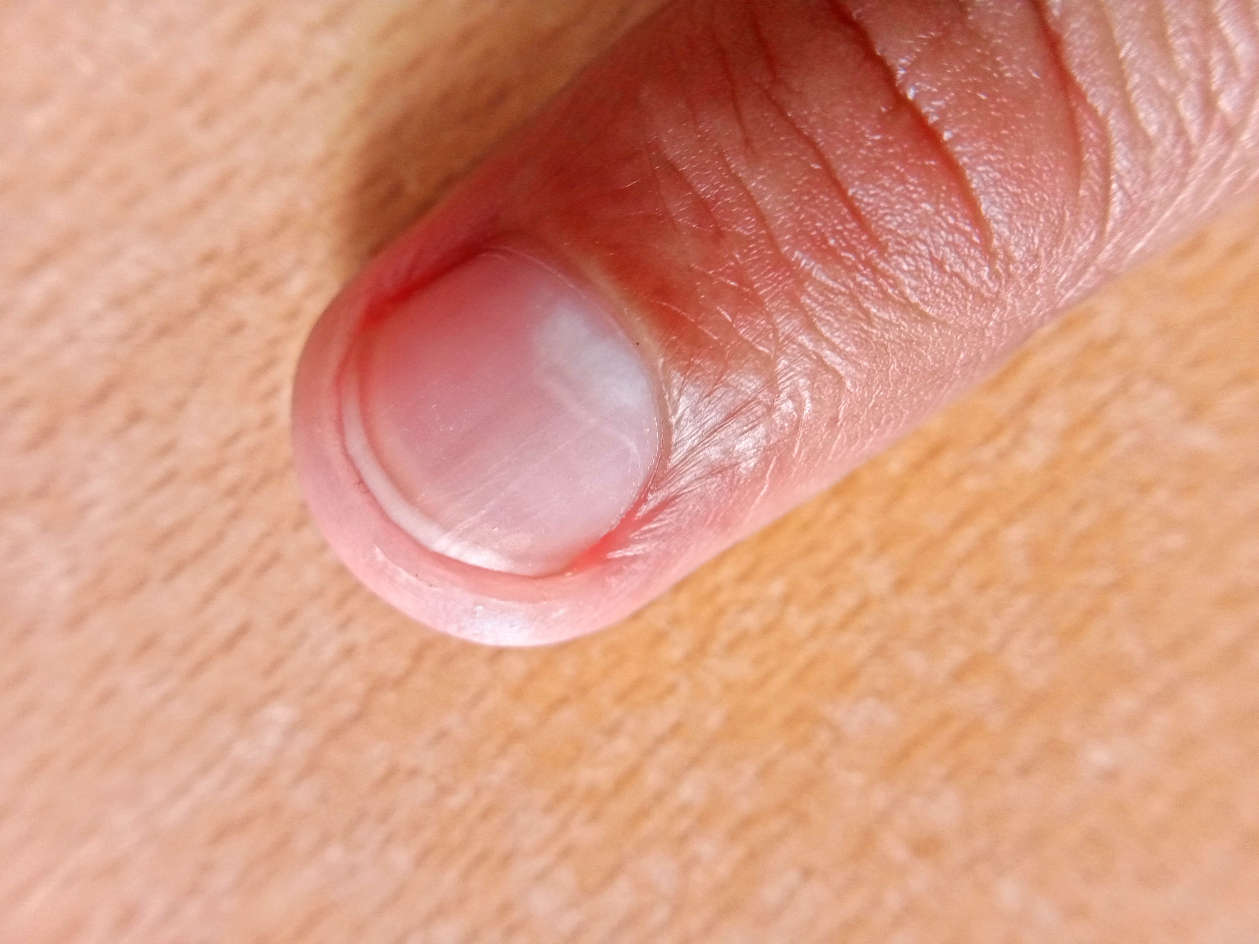 white spots on nails