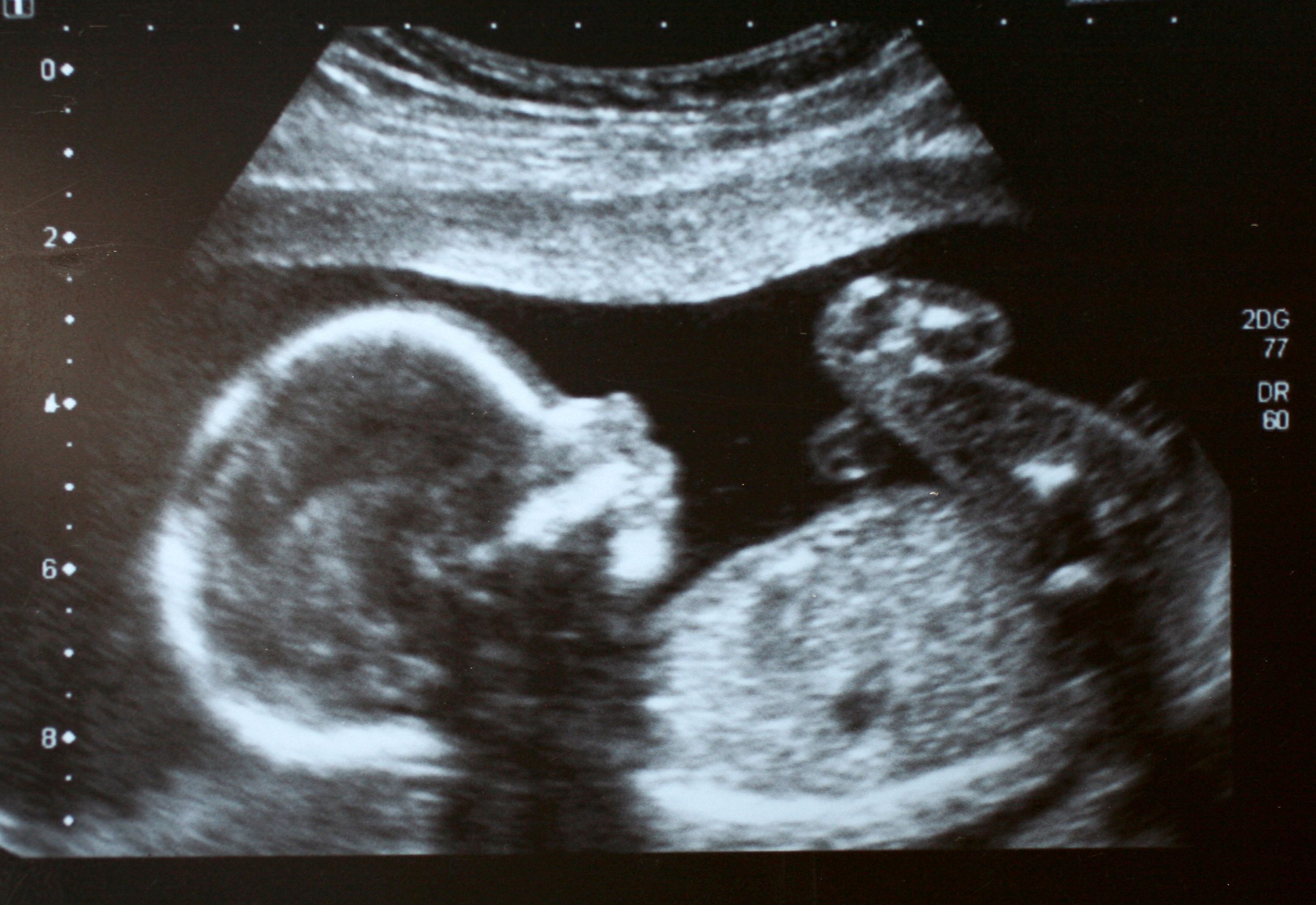 Foetus ultrasound Foetus ultrasound