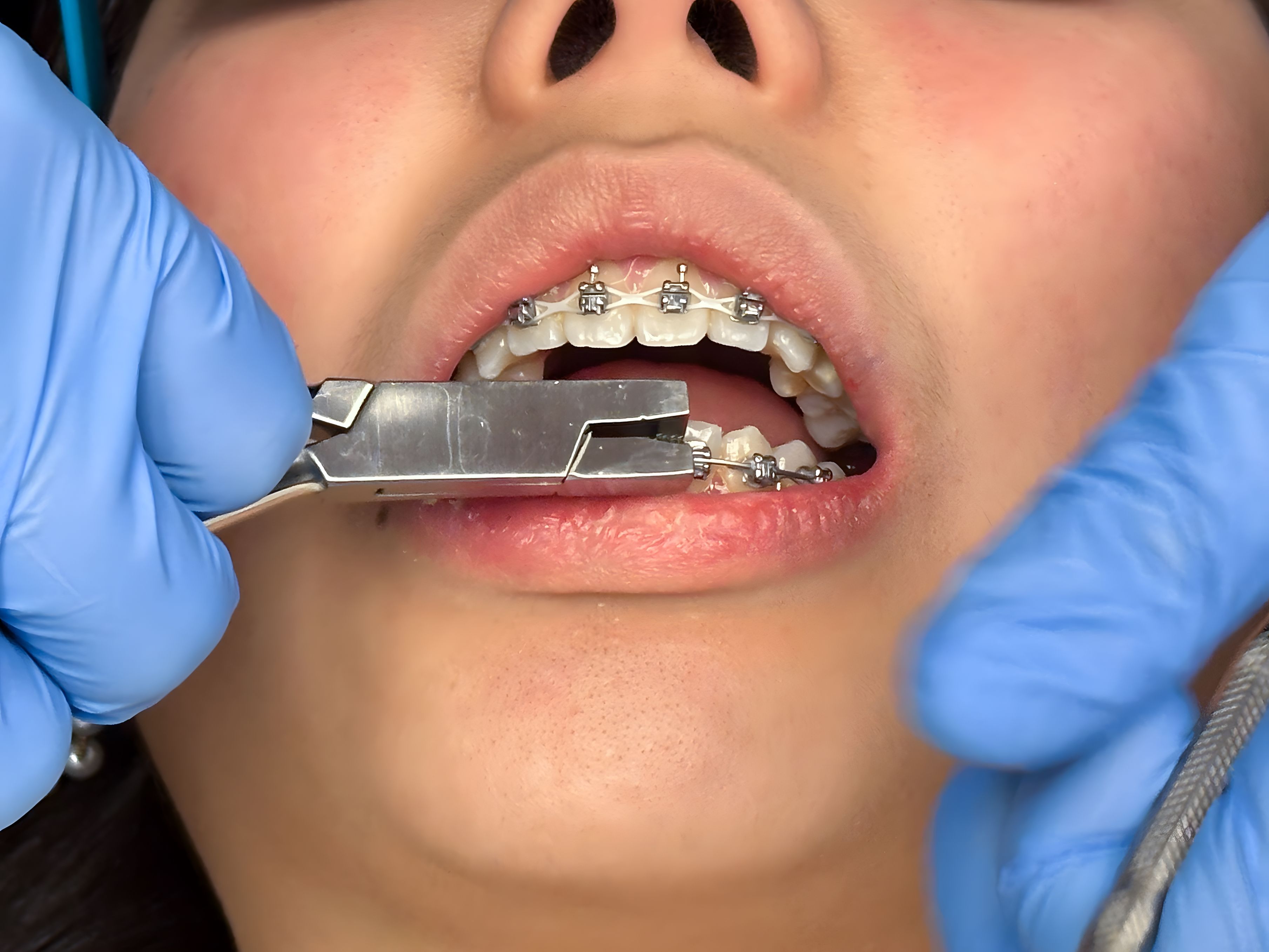 orthodontic adjustment