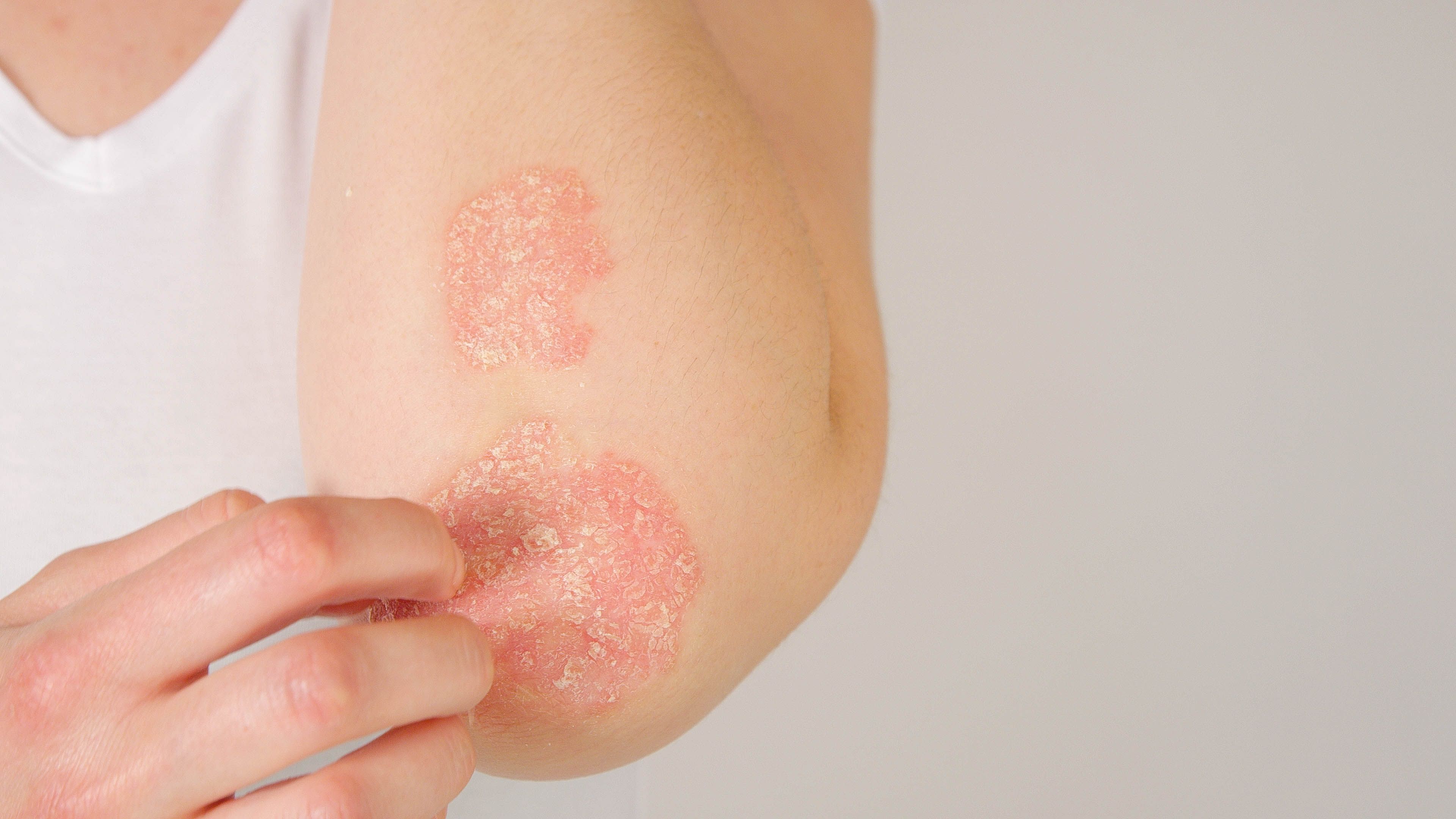 psoriasis symptoms
