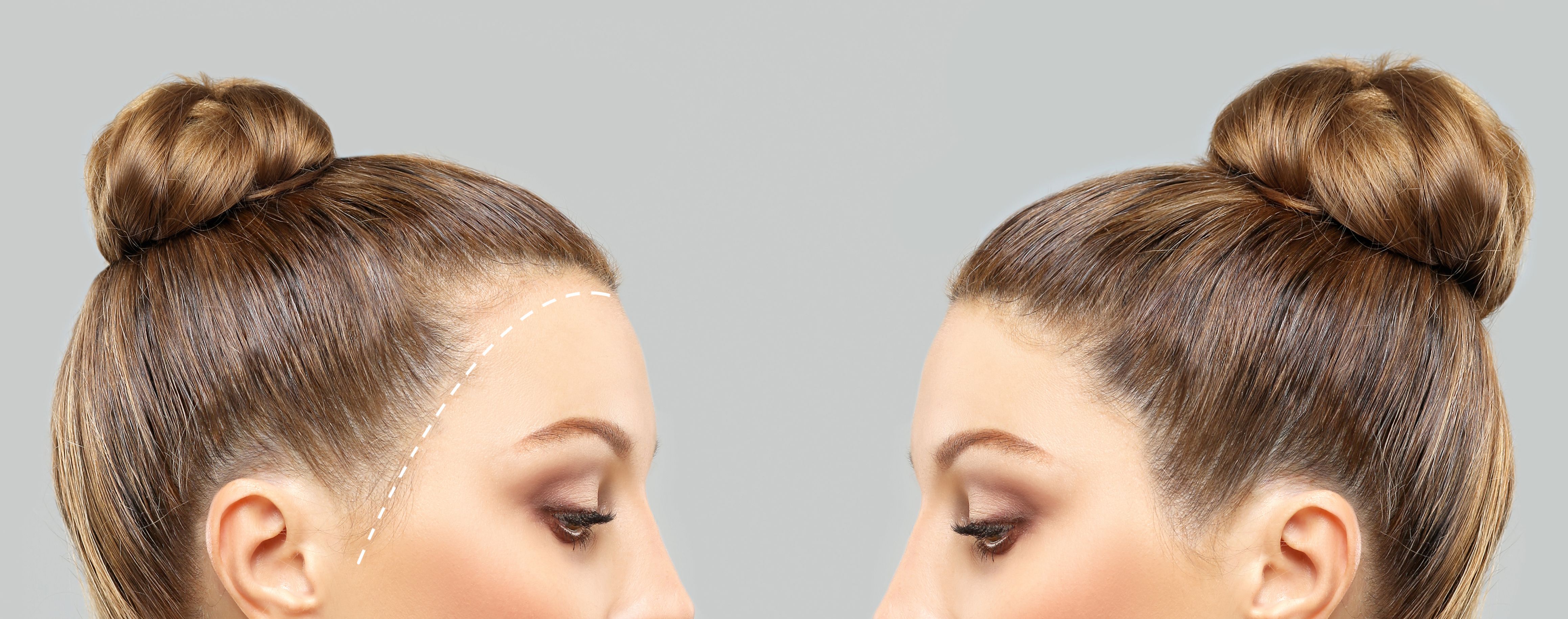 women hair transplant