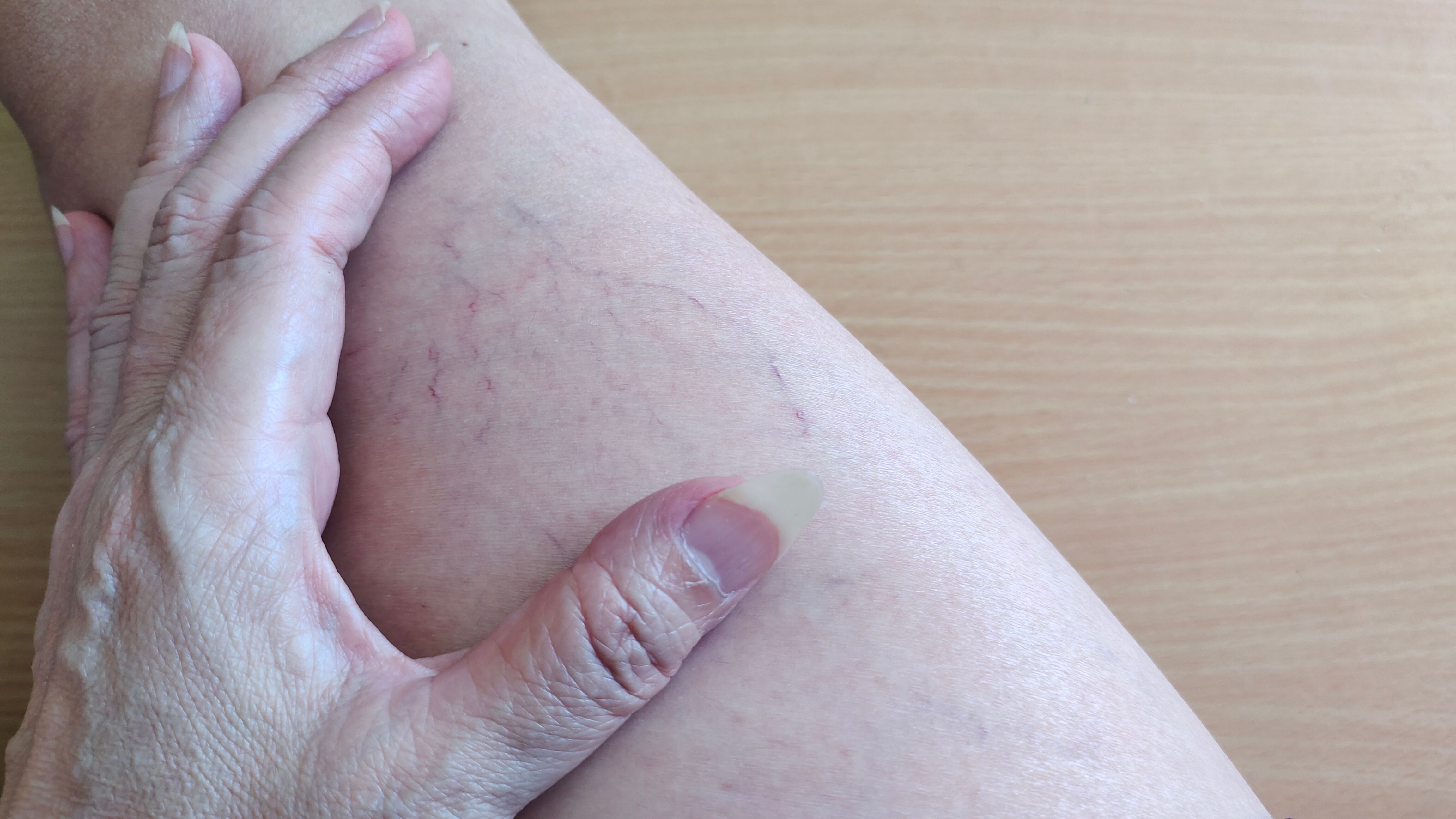 The varicose veins, blood spider.
