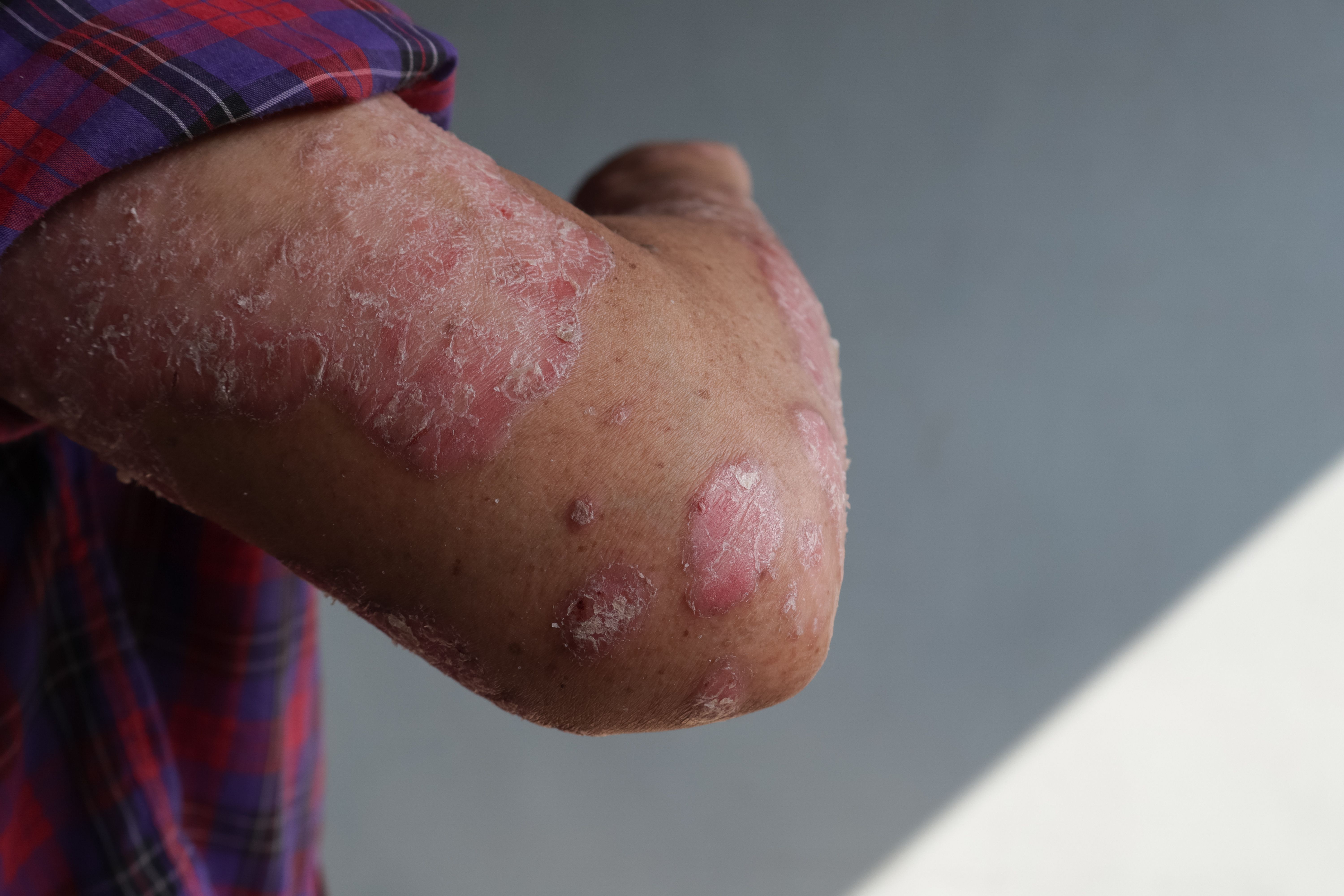 psoriasis treatment