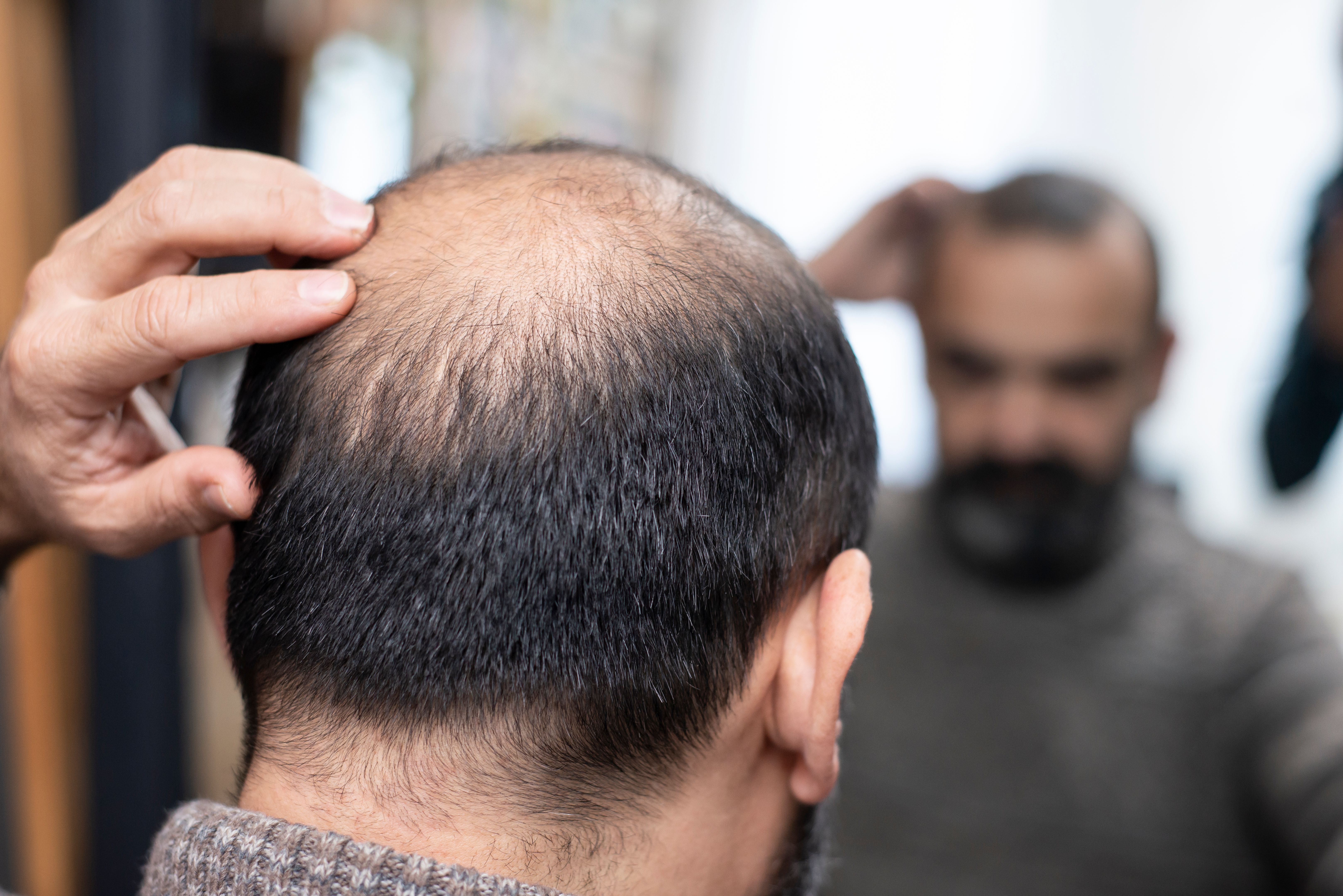 Finasteride hair loss treatment leicester Finasteride hair loss treatment leicester