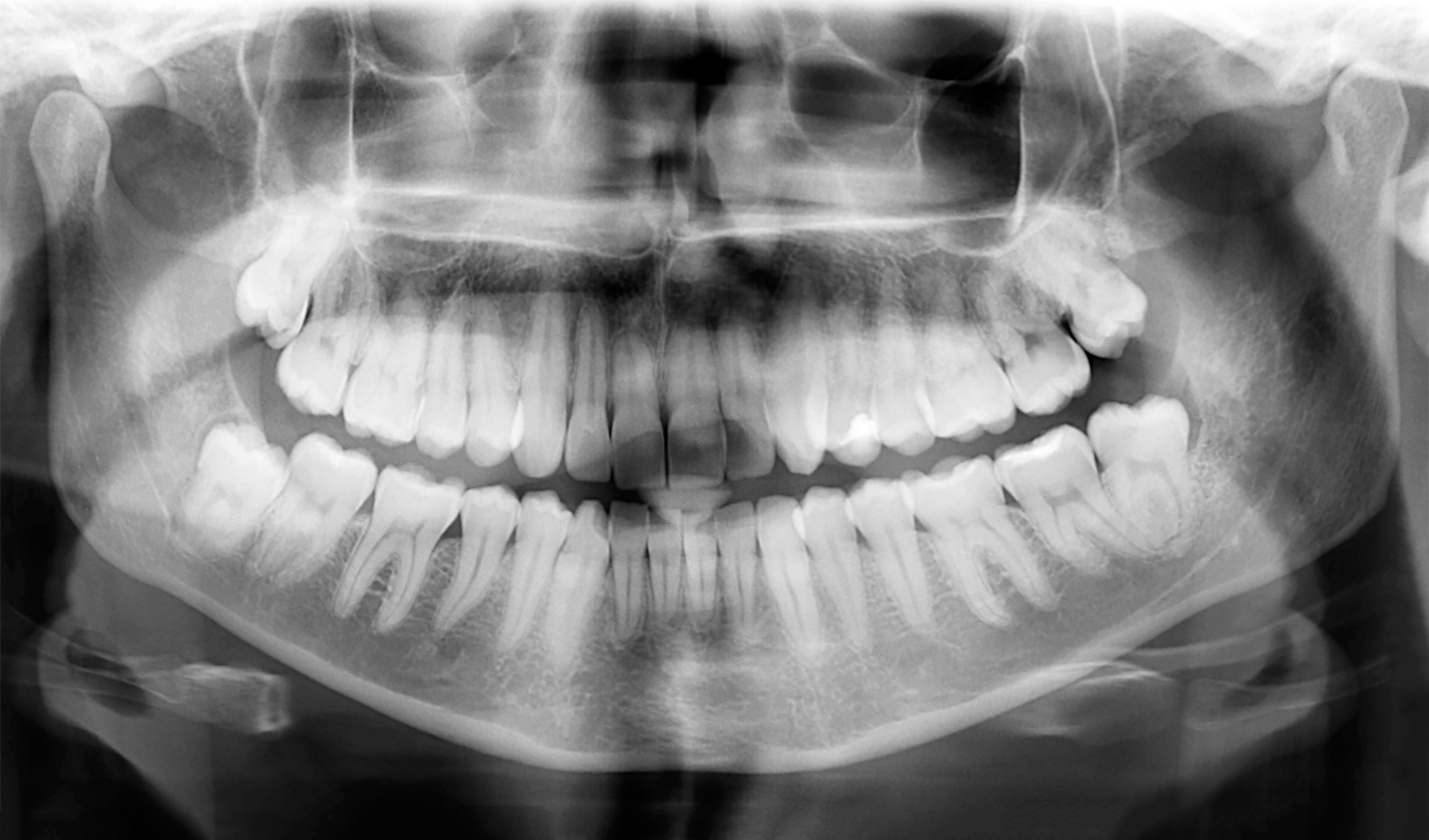 panoramic dental x-ray