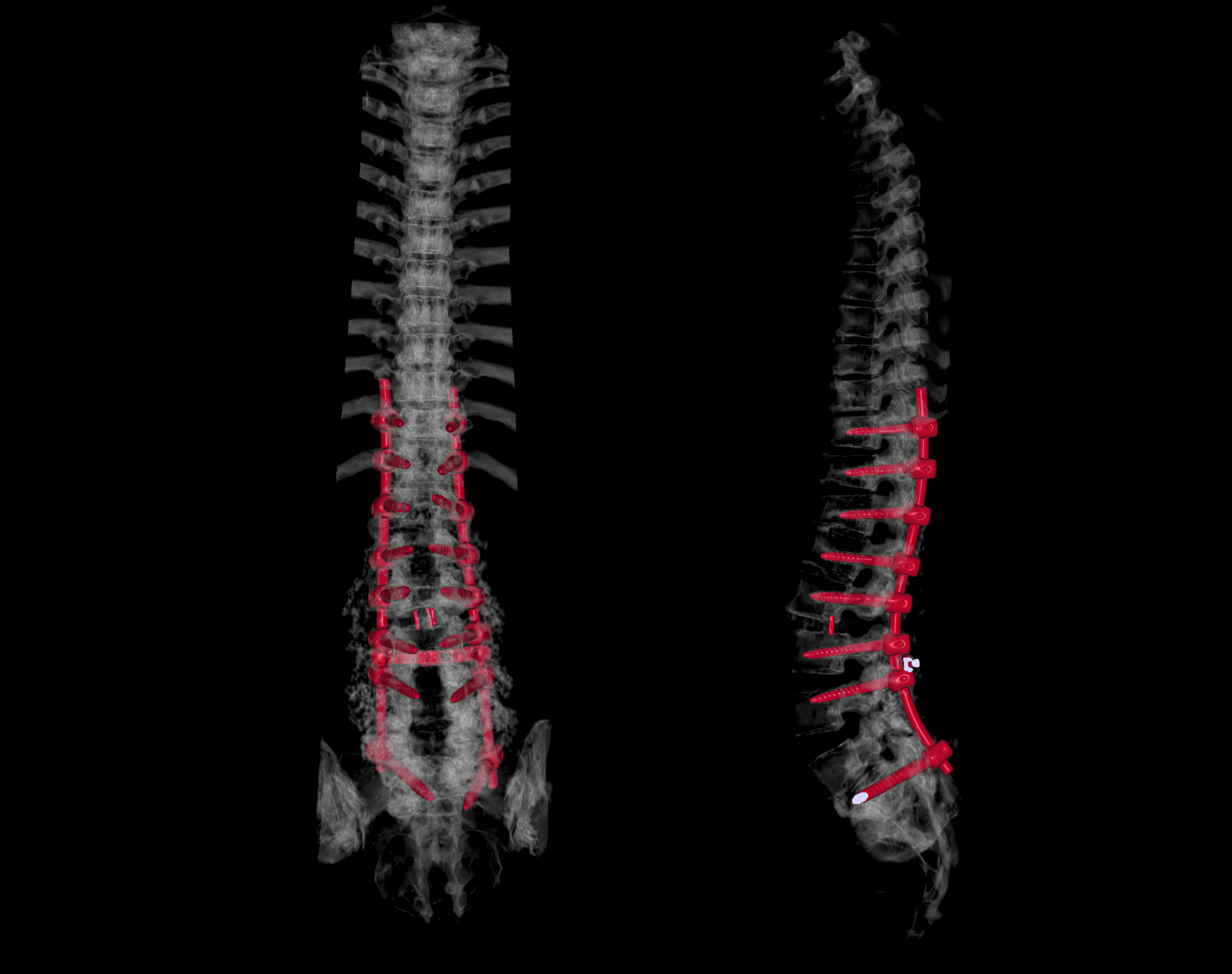 spinal decompression therapy