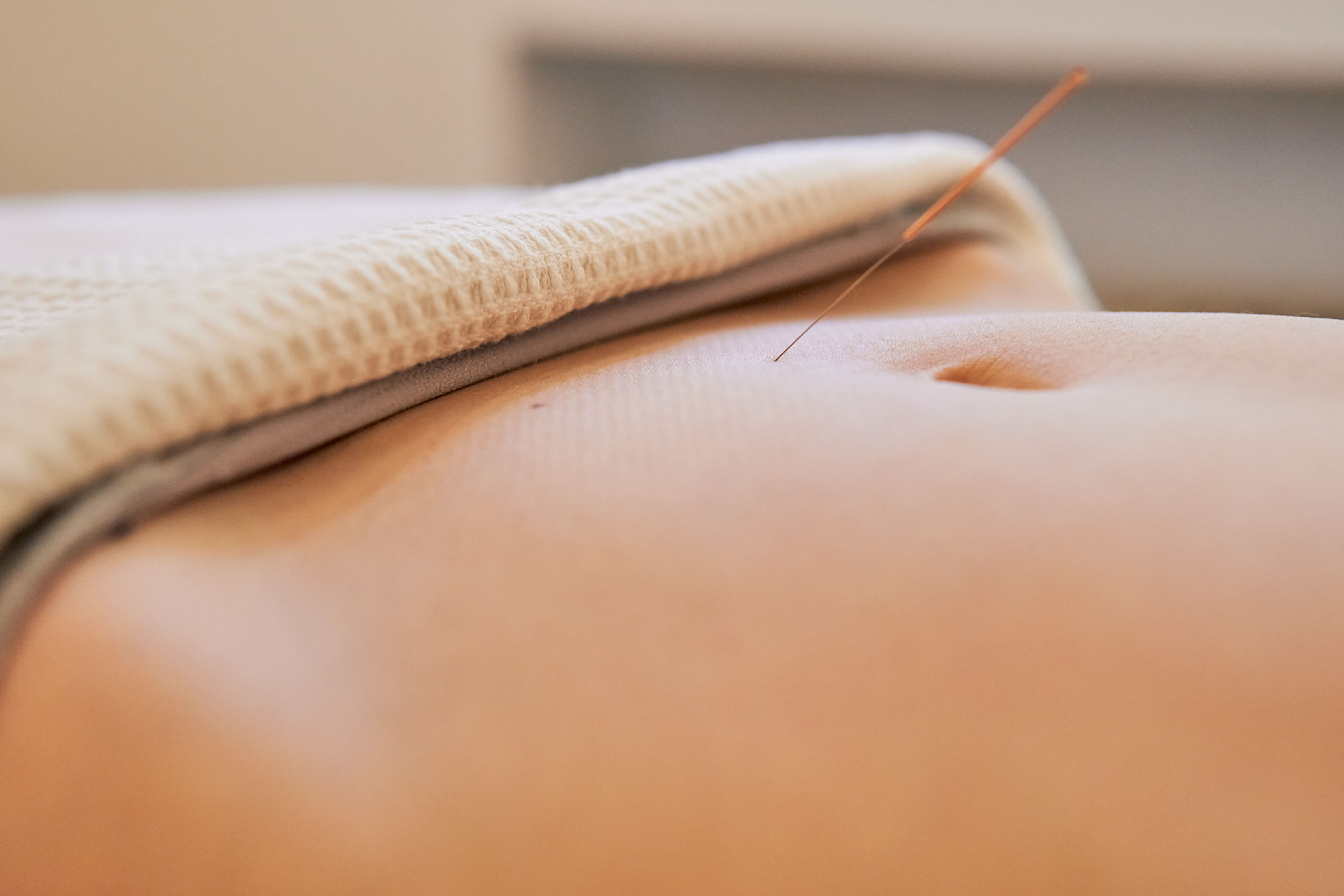 fertility acupuncture