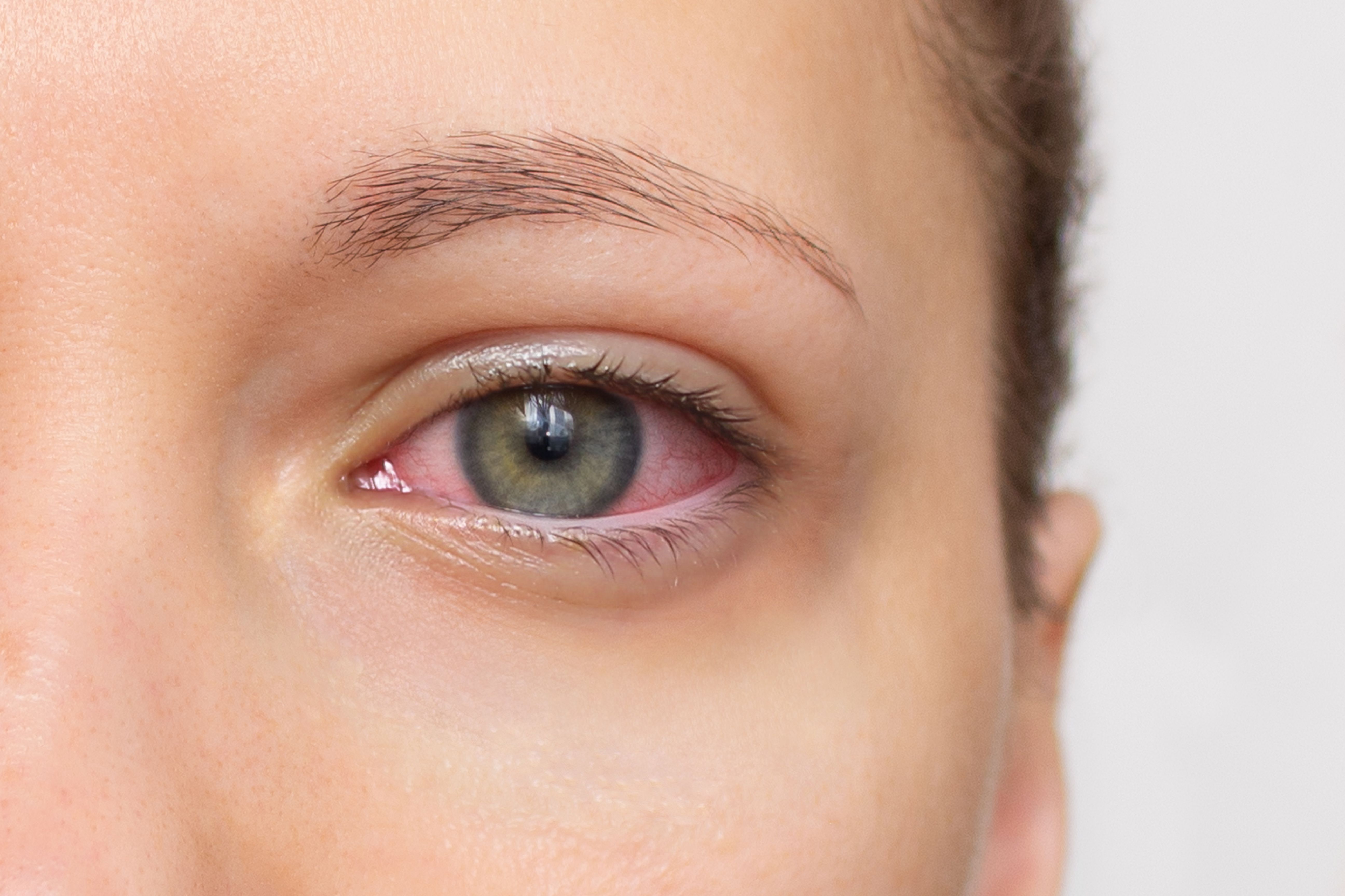 eye symptoms