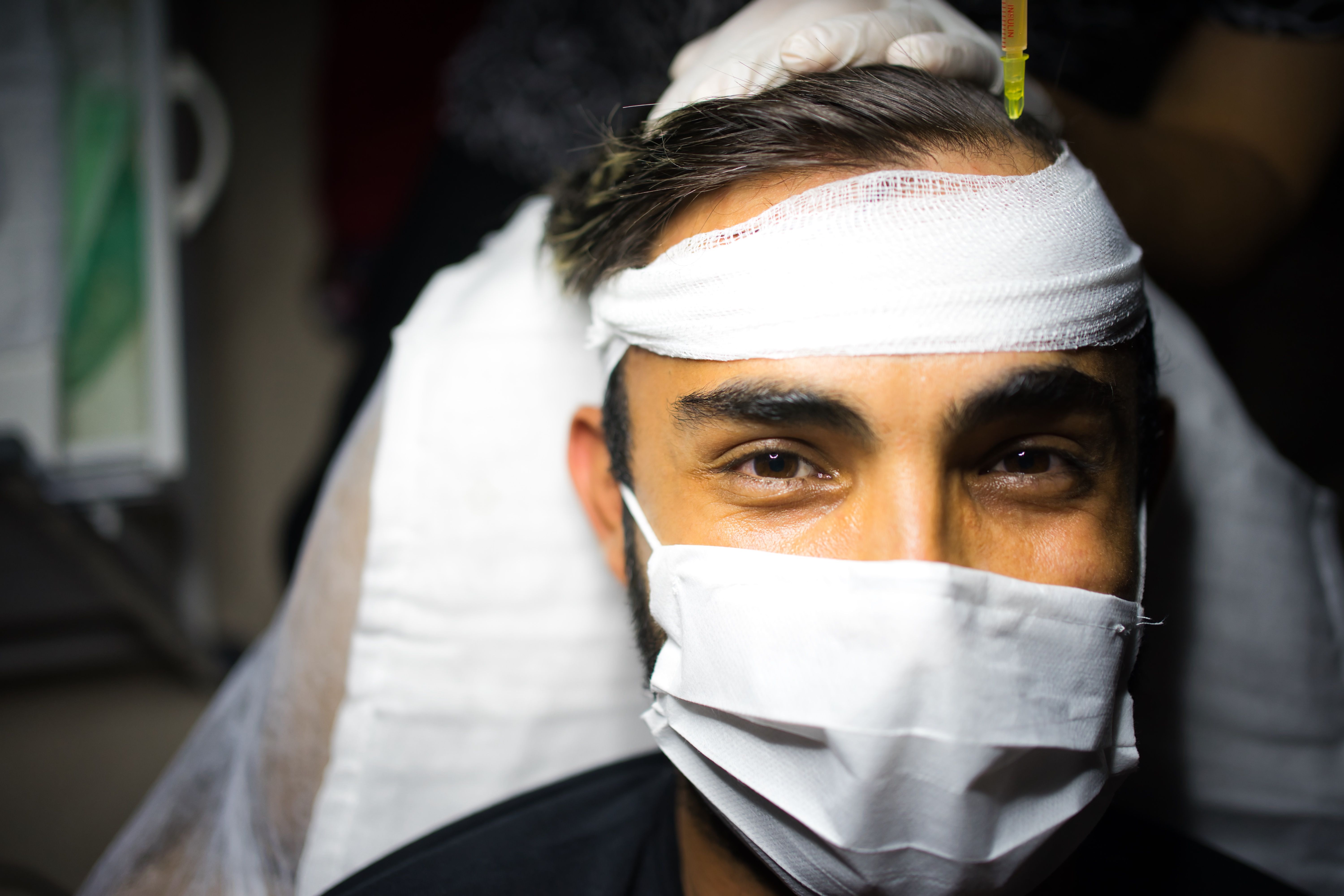 fue hair transplant recovery