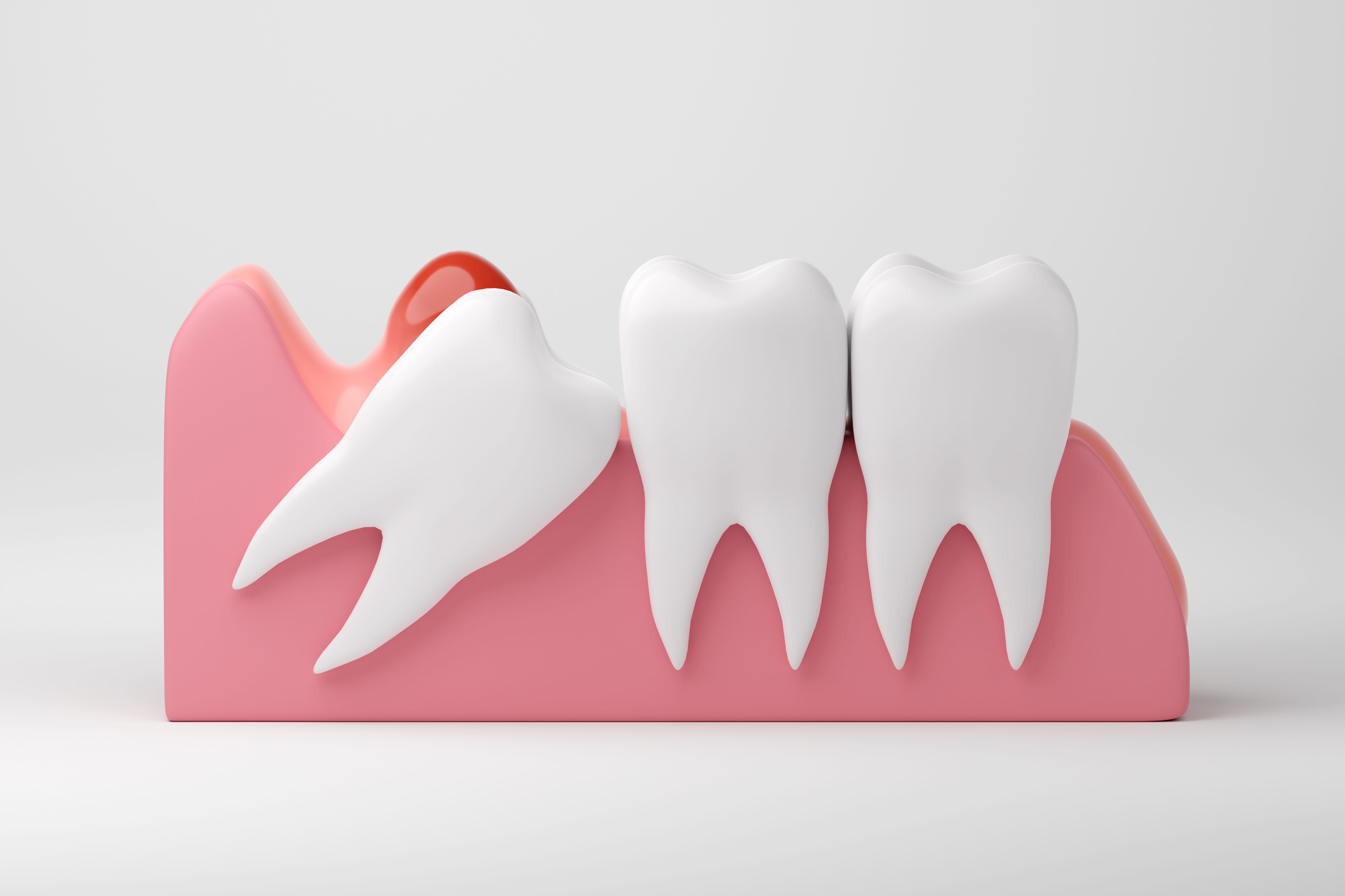 wisdom tooth infection