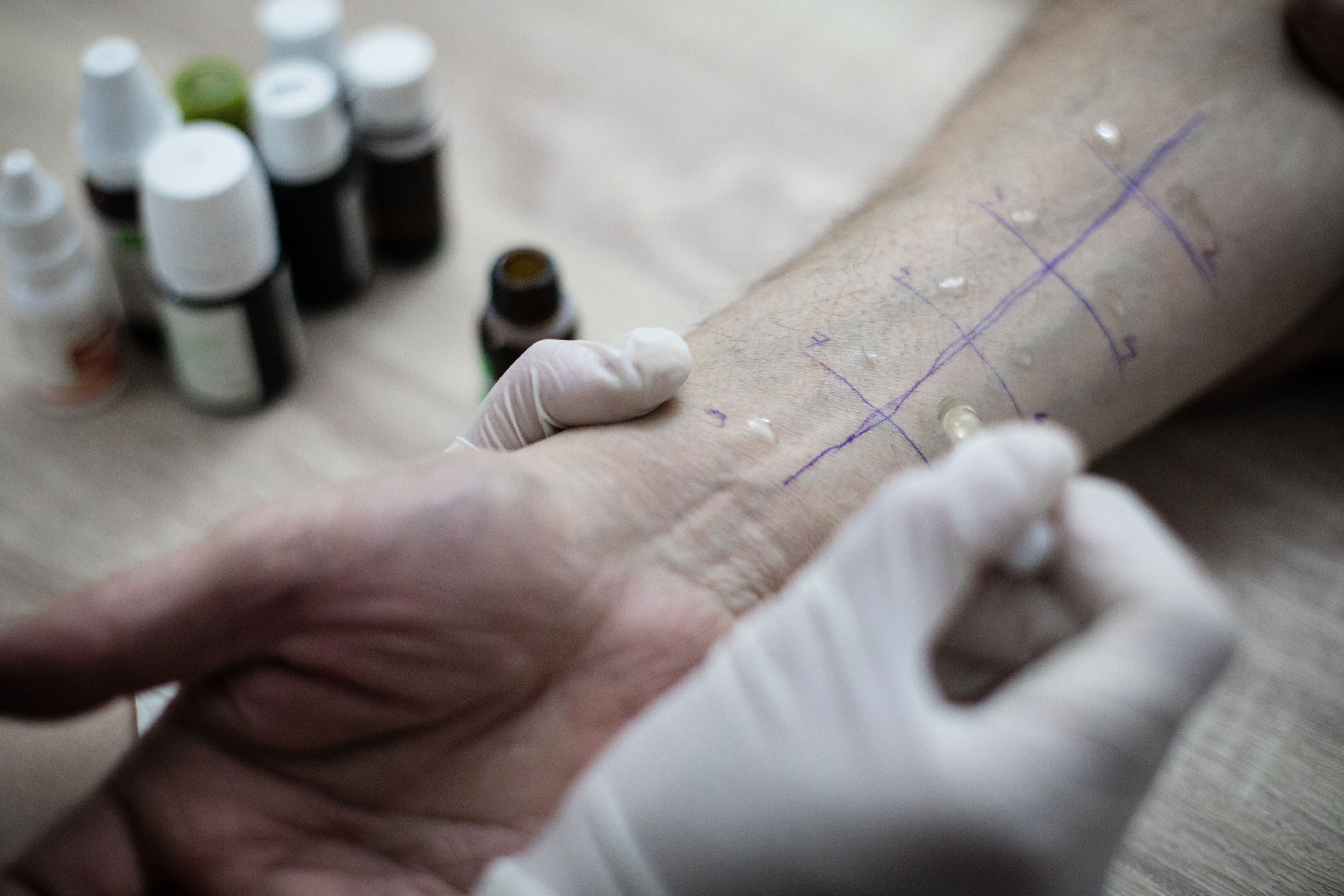 ingrown hair treatment