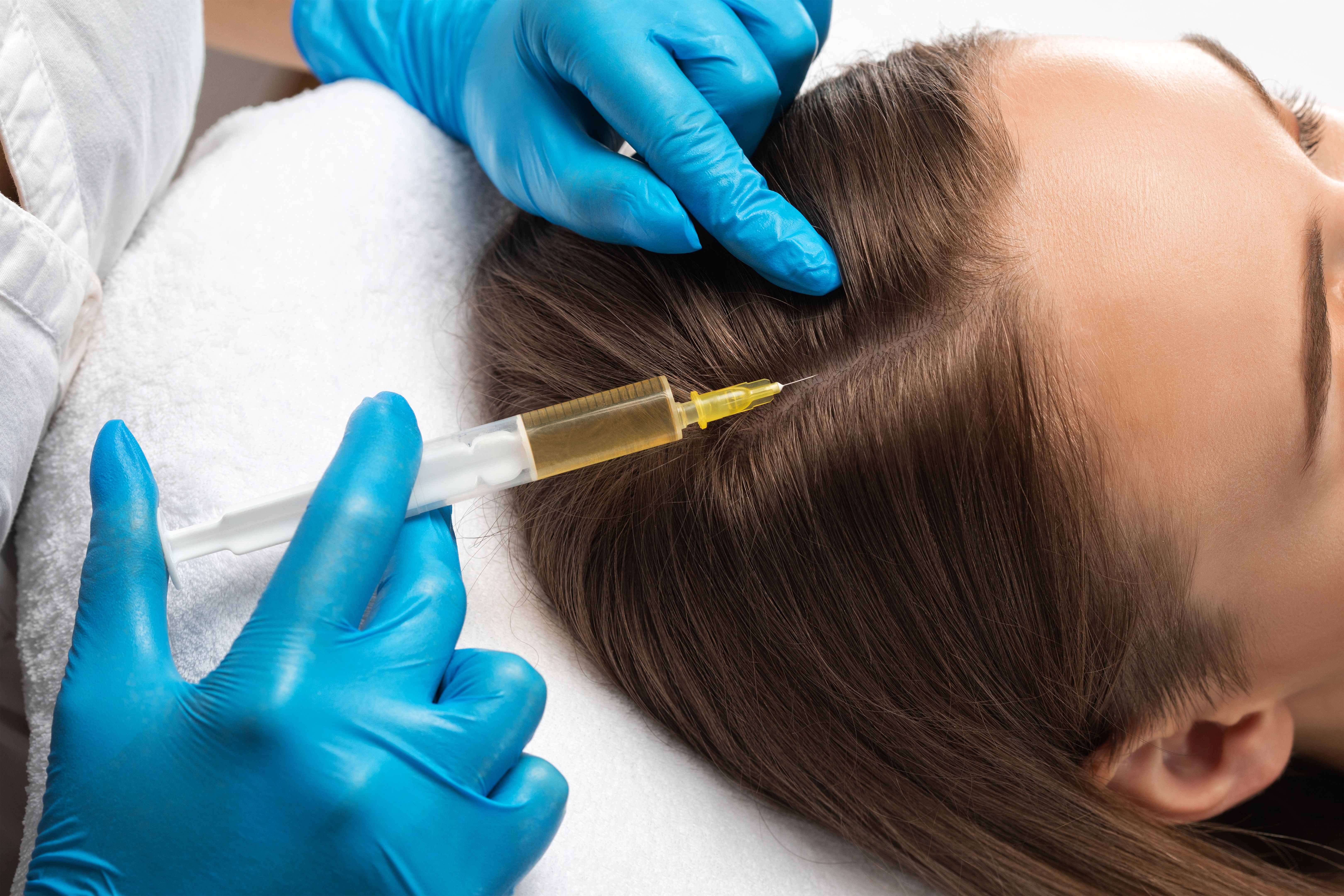 PRP therapy hair