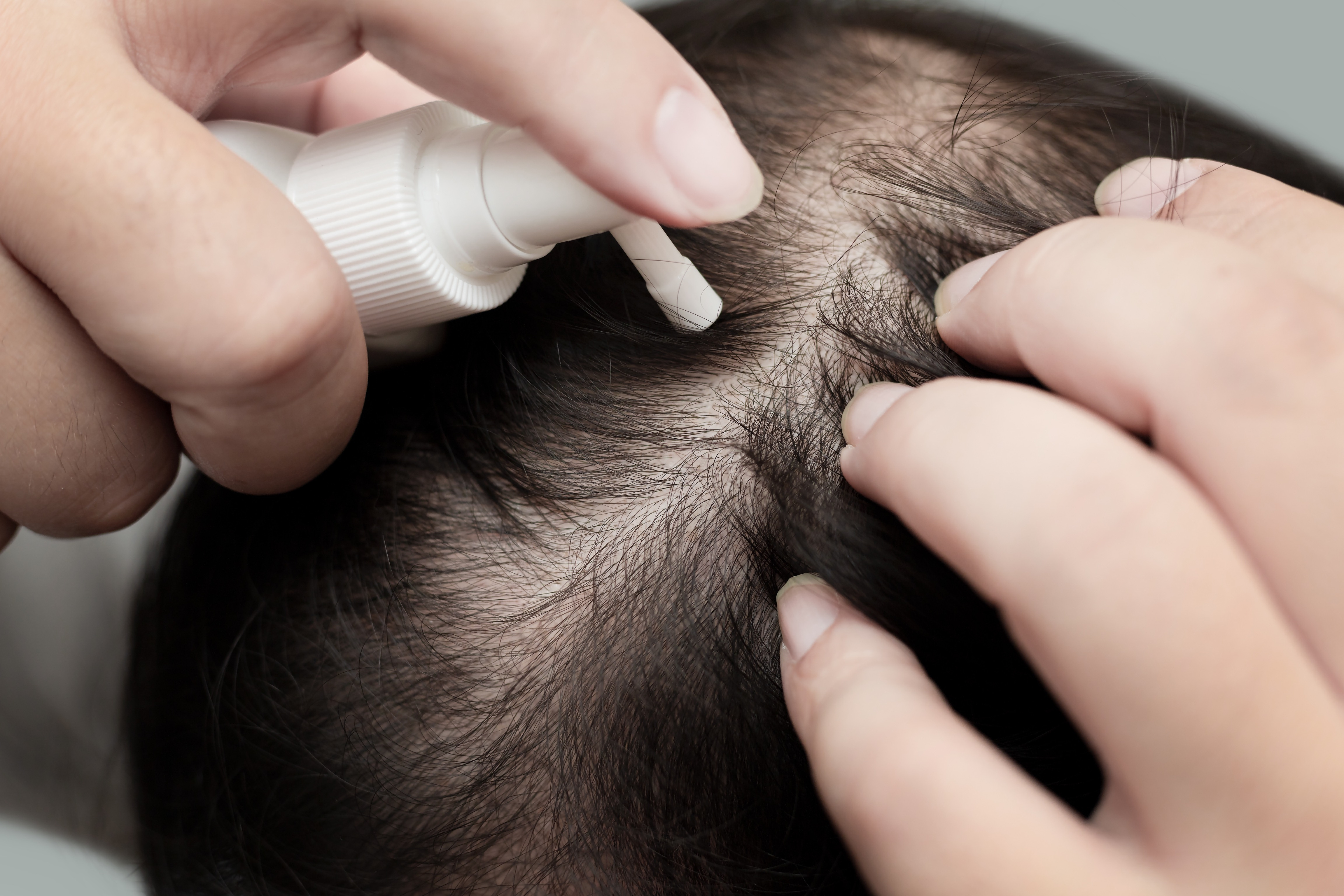 Close up of male’s hand using medication on scalp, treating for Alopecia, hair loss, dandruff or hair problem Close up of male’s hand using medication on scalp, treating for Alopecia, hair loss, dandruff or hair problem