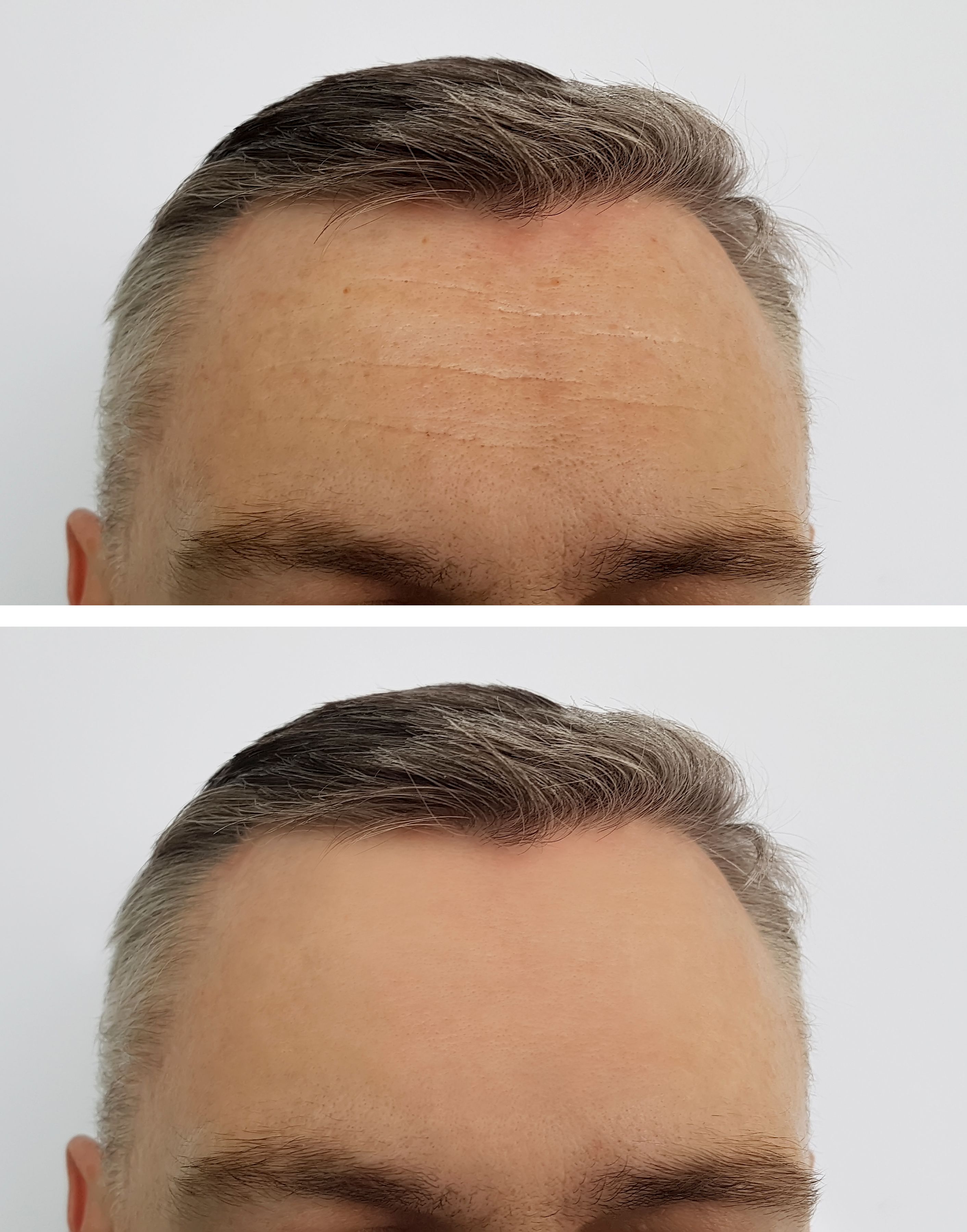 natural botox results